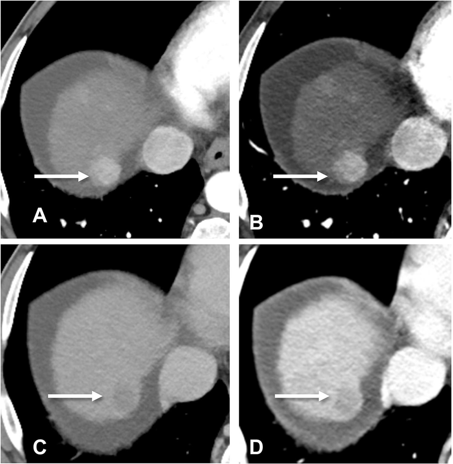 Dual-energy computed tomography demonstrating a hepatocellular carcinoma with arterial phase hyperenhancement on 0.6 linear blend (A) and 50 keV (B) imaging.