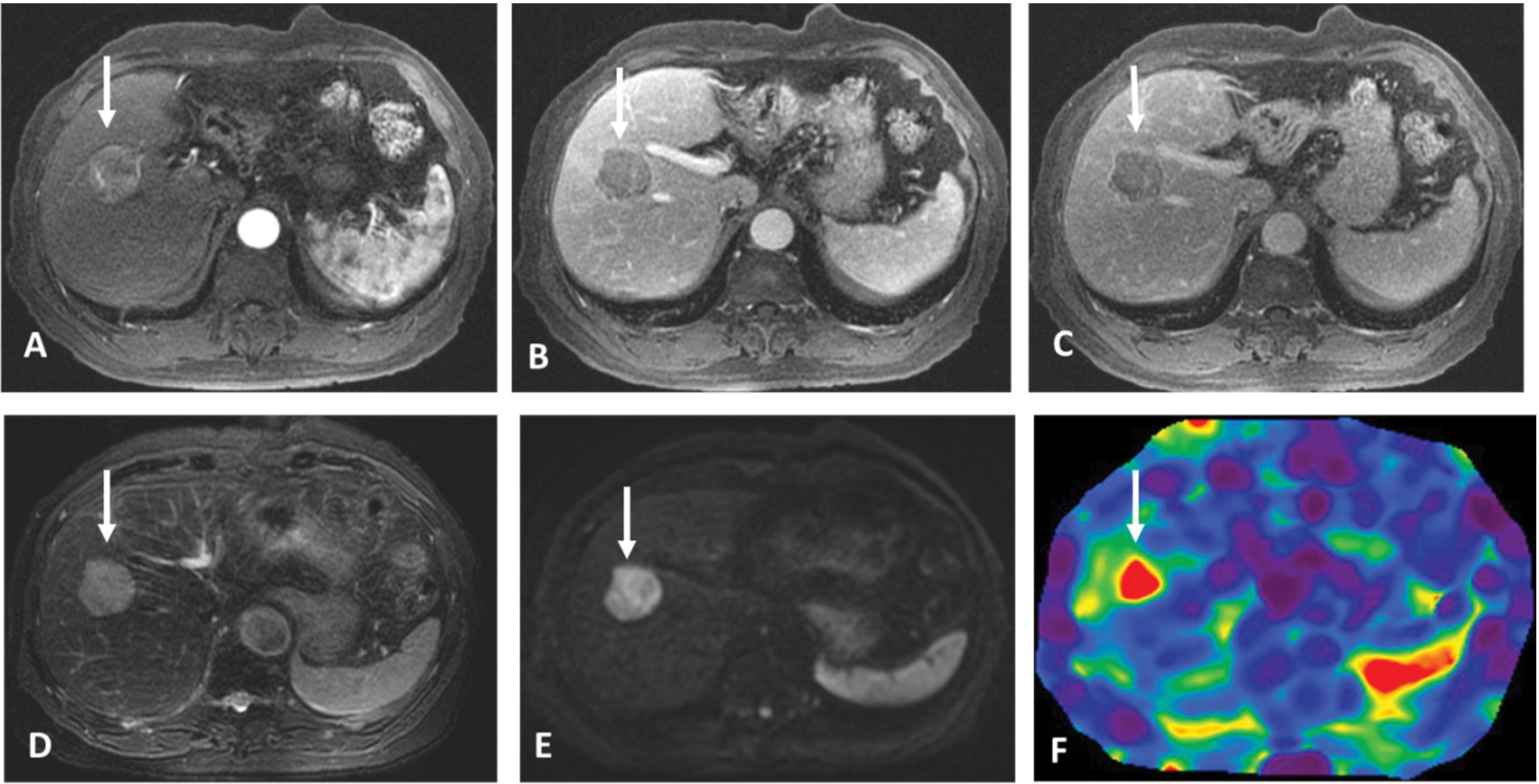 Axial magnetic resonance imaging of the abdomen of a 63-year-old patient with chronic hepatitis.