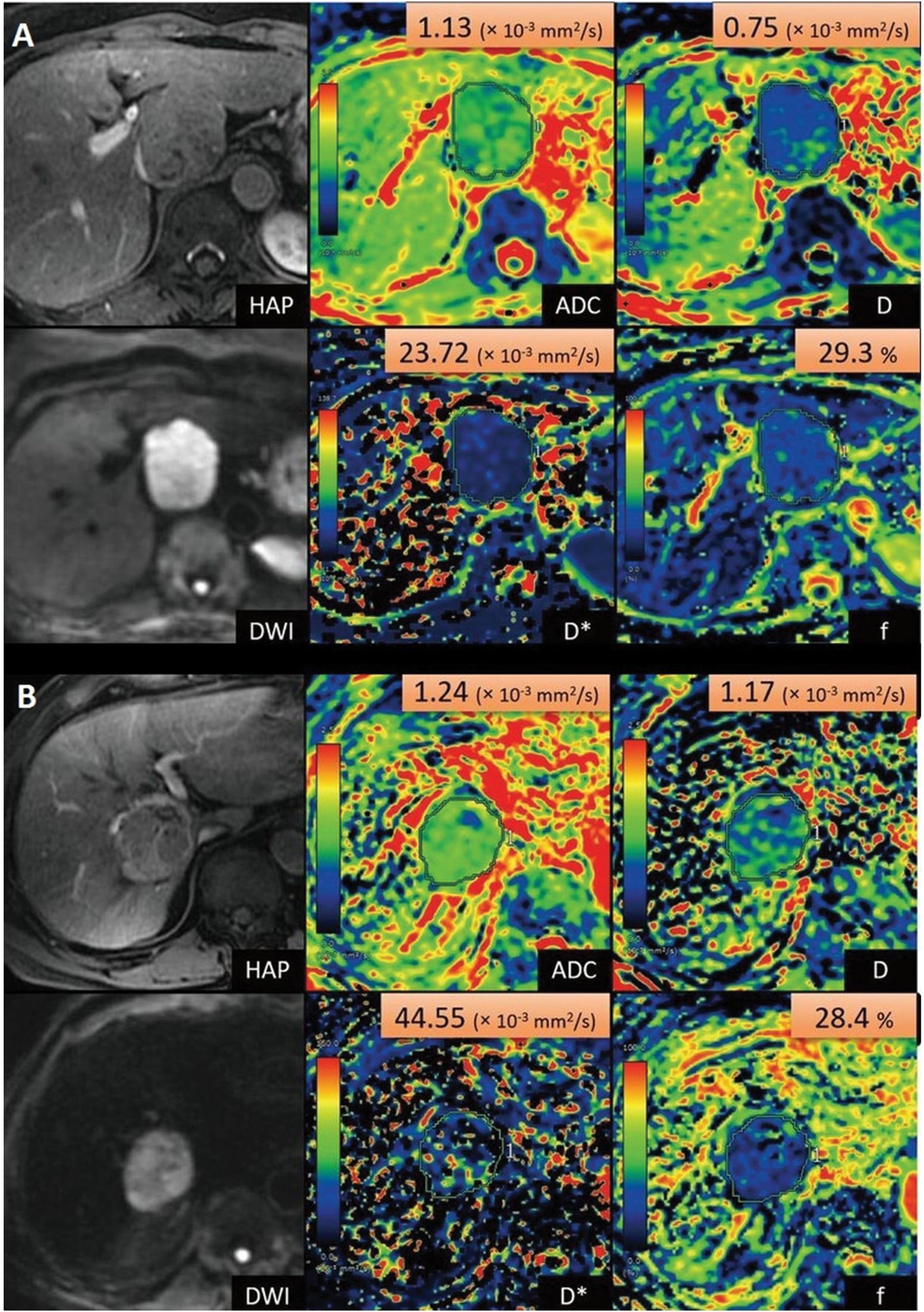 Intravoxel incoherent motion imaging of hepatocellular carcinoma.