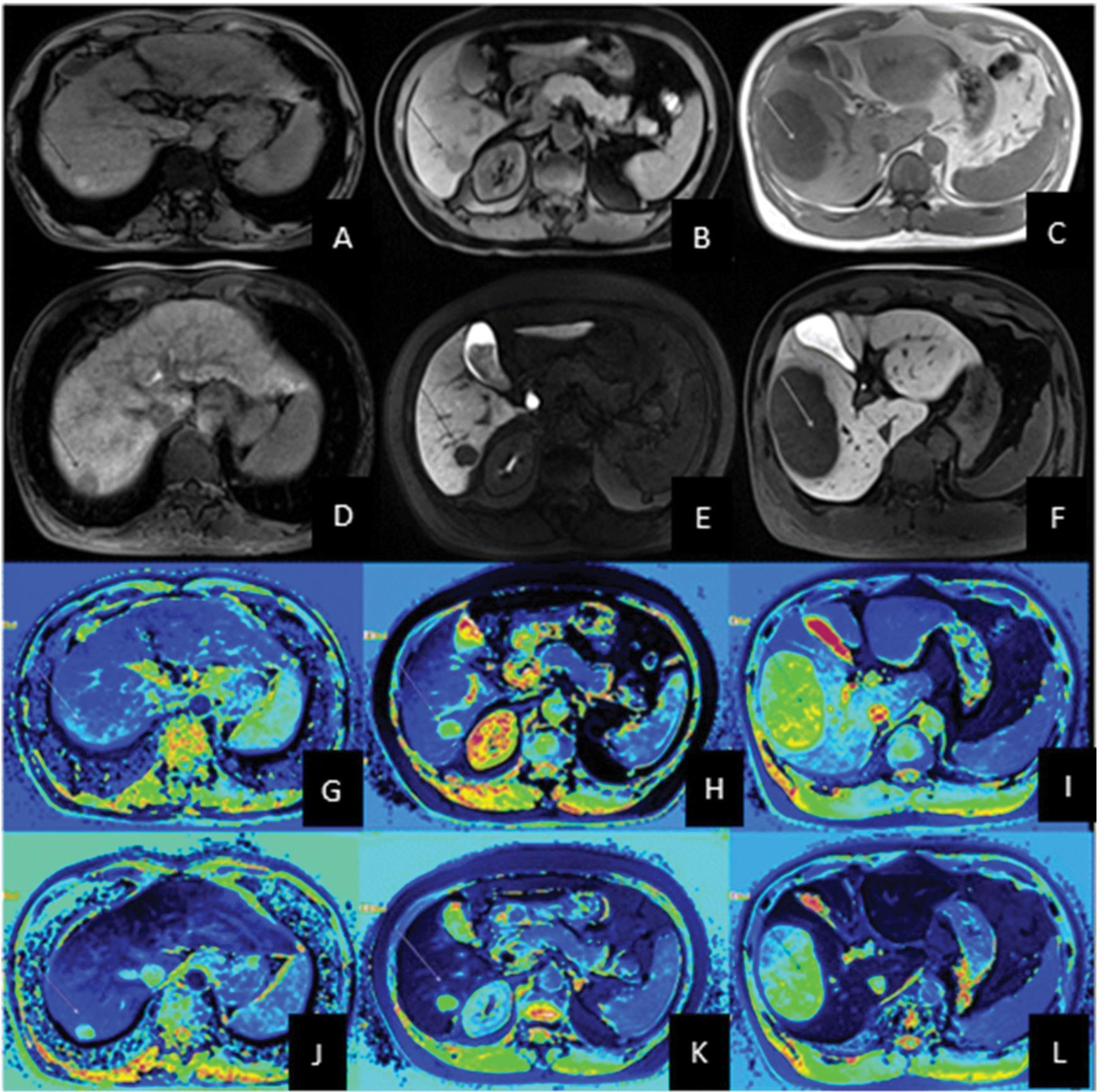 Magnetic resonance imaging of the abdomen of separate patients with low grade (column 1), intermediate grade (column 2) and high grade (column 3) hepatocellular carcinoma.