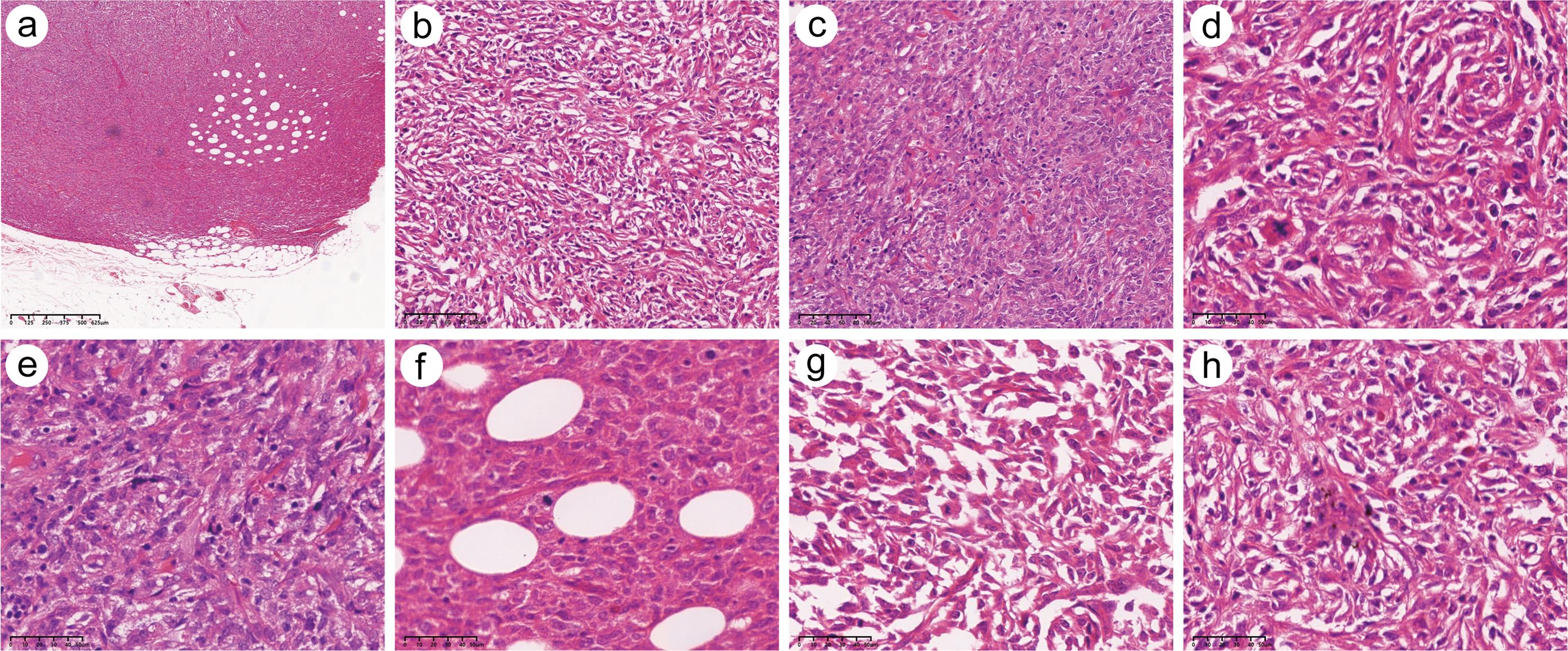 Representative hematoxylin and eosin (H&E) stains of the axillary mass tissue: the tumor tissue was located within the dermis, with relatively well-defined borders and focal extension into the subcutaneous adipose tissue (a, original magnification, ×40; scale bar, 125 µm). The tumor cells exhibited a slightly storiform growth pattern (b–c, original magnification, ×200; scale bar, 20 µm).