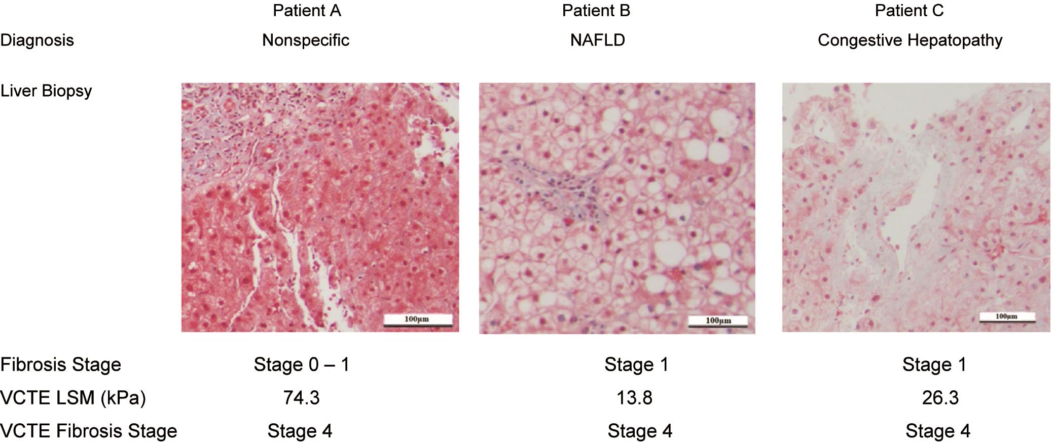 Representative cases in which fibrosis stage determined by VCTE LSM significantly overstated histopathological fibrosis on liver biopsy.