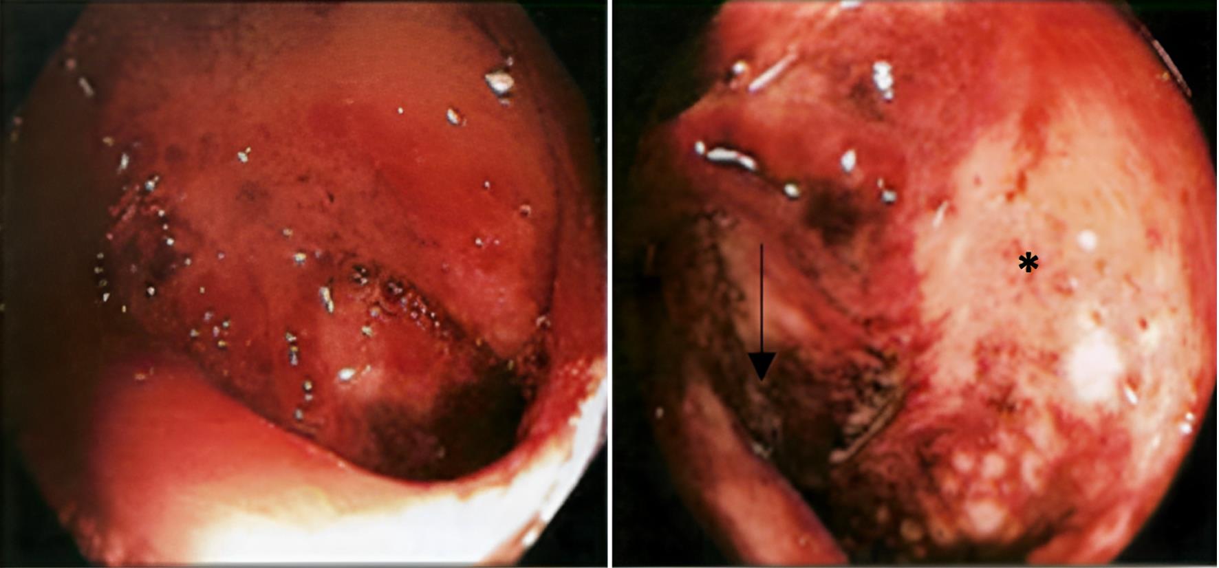 A clinical photograph of the colonic mucosa during endoscopy of the descending colon, revealing necrotic areas (black arrow) and abnormal vascular patterns (black asterisk).