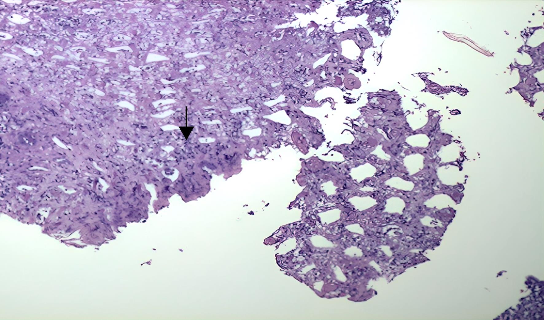 Light microscopy (4×) of the affected colonic mucosa stained with hematoxylin and eosin, showing mucosal atrophy and mononuclear infiltrates (black arrow).