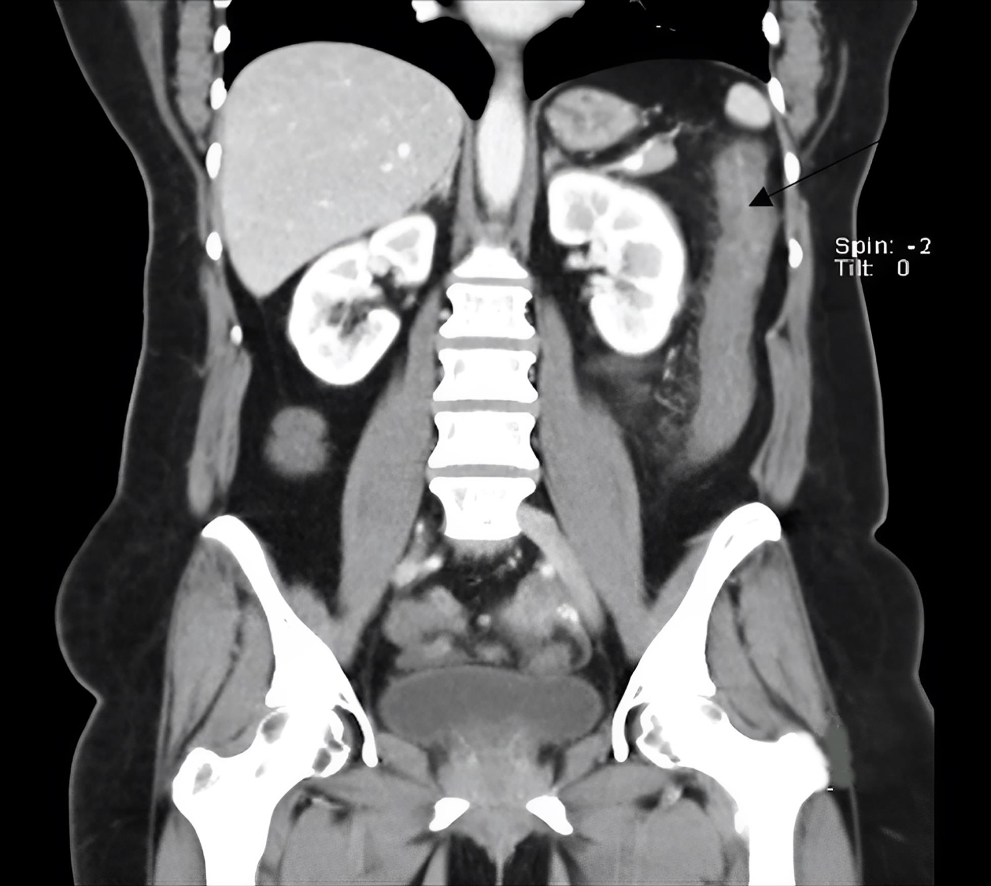 Computed tomography enterography on coronal section, revealing inflammation in the descending colon (white arrow).