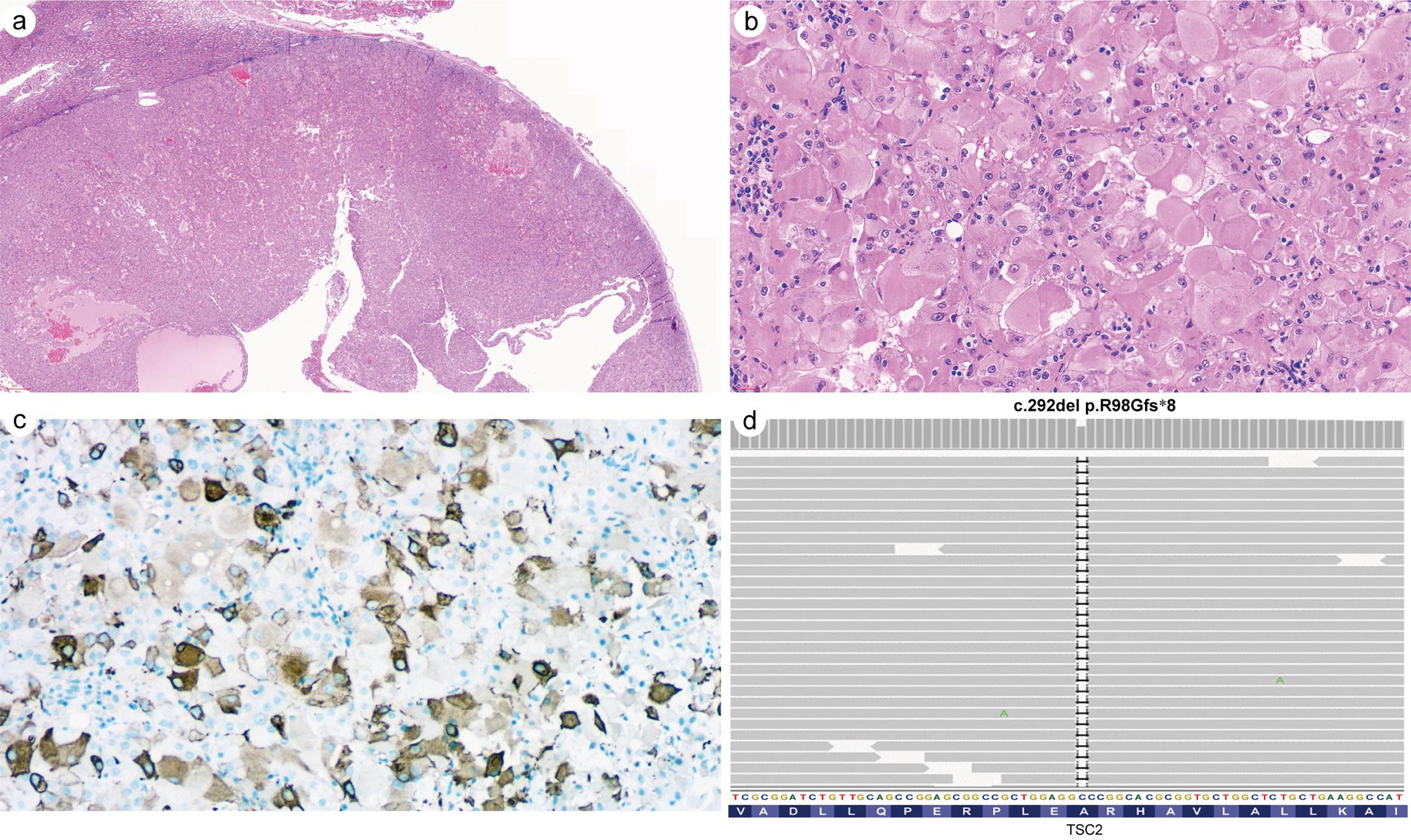 Eosinophilic solid and cystic renal cell carcinoma (ESC-RCC).