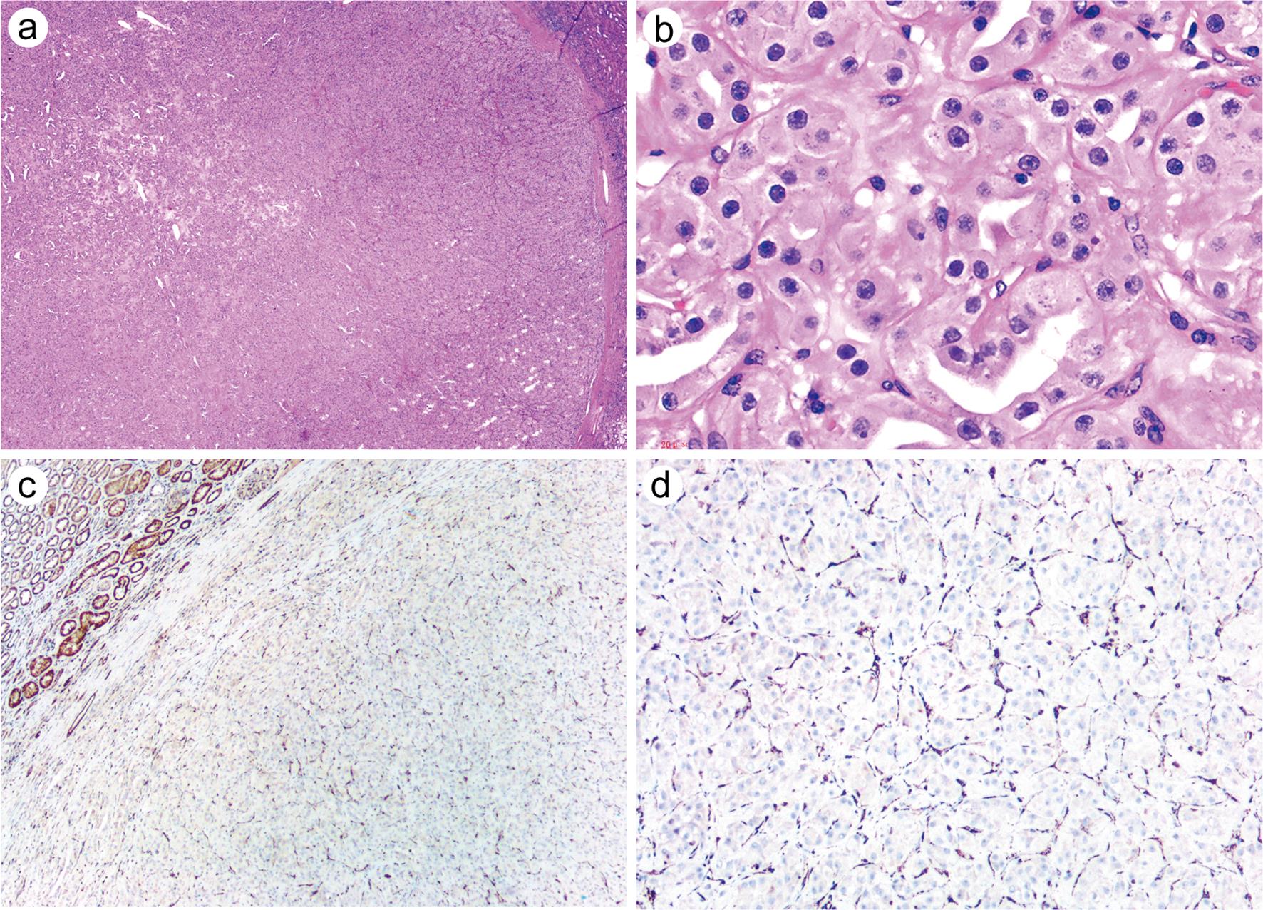 Low-grade oncocytic fumarate hydratase-deficient renal cell carcinoma.