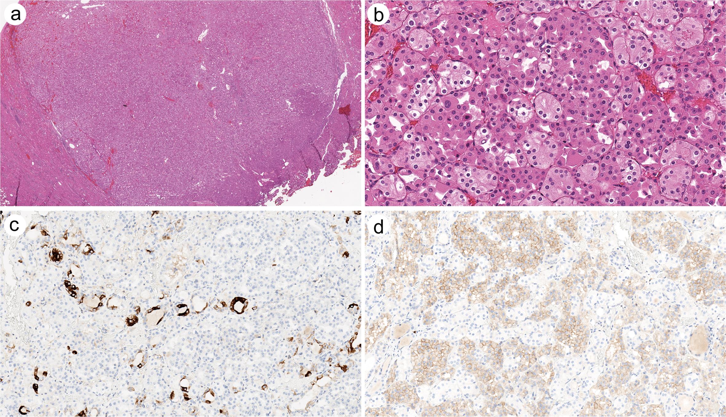 A hybrid oncocytic/chromophobe renal tumor (HOCT) from a patient with Birt-Hogg-Dube syndrome.