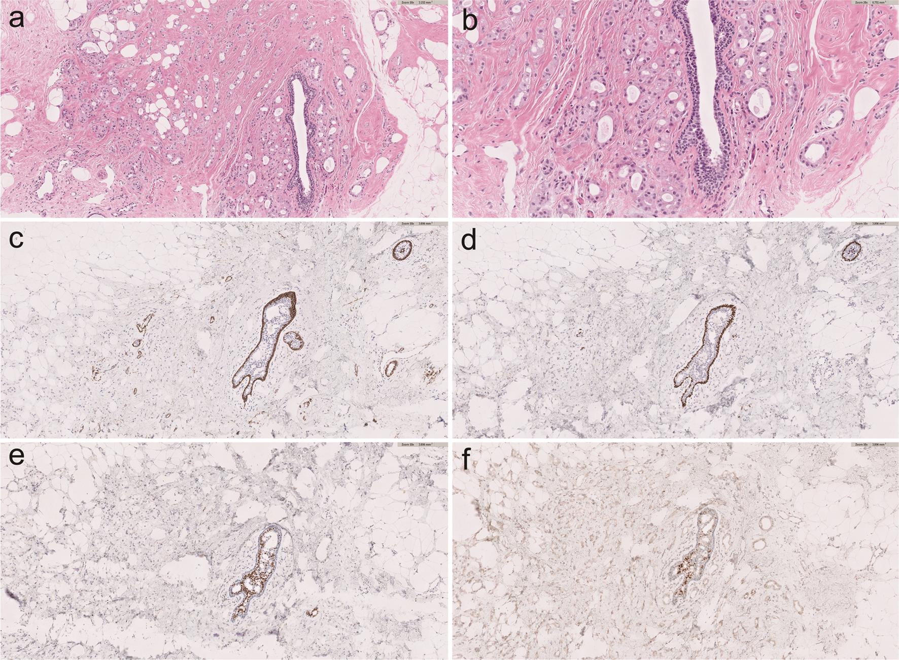 Morphological and Immunohistochemical Characteristics of Low-Grade Invasive Apocrine Carcinoma of the Breast.