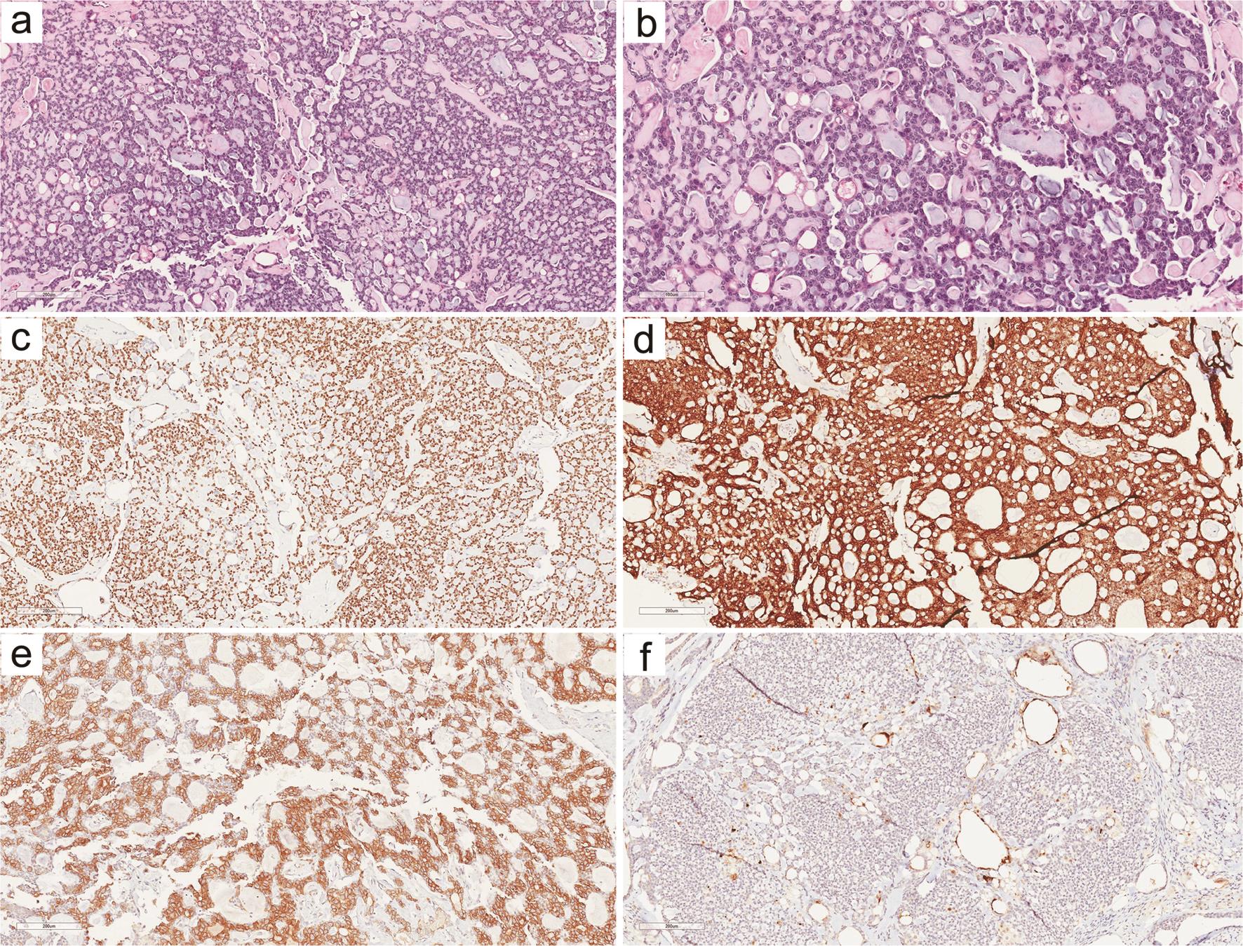 Histopathological and Immunohistochemical Features of Classic Adenoid Cystic Carcinoma of the Breast.