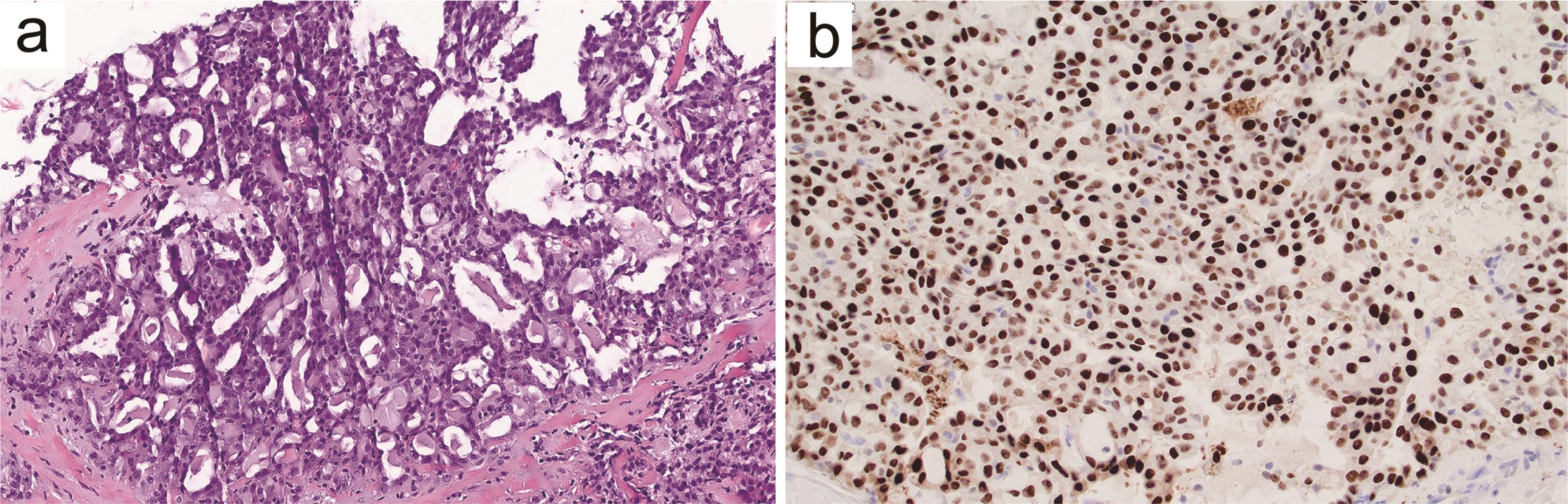 Secretory carcinoma of the breast.