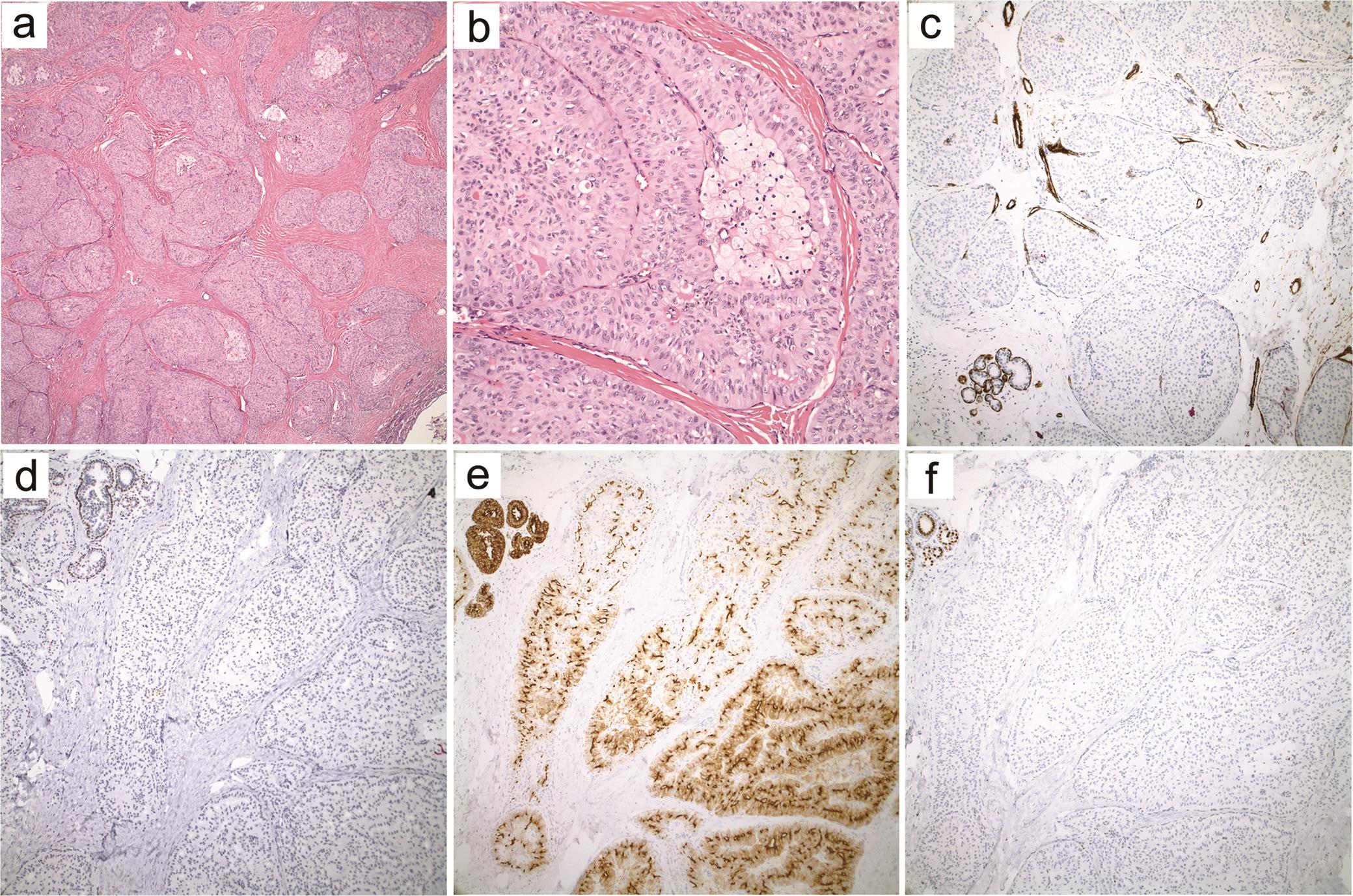 Tall cell carcinoma with reversed polarity.