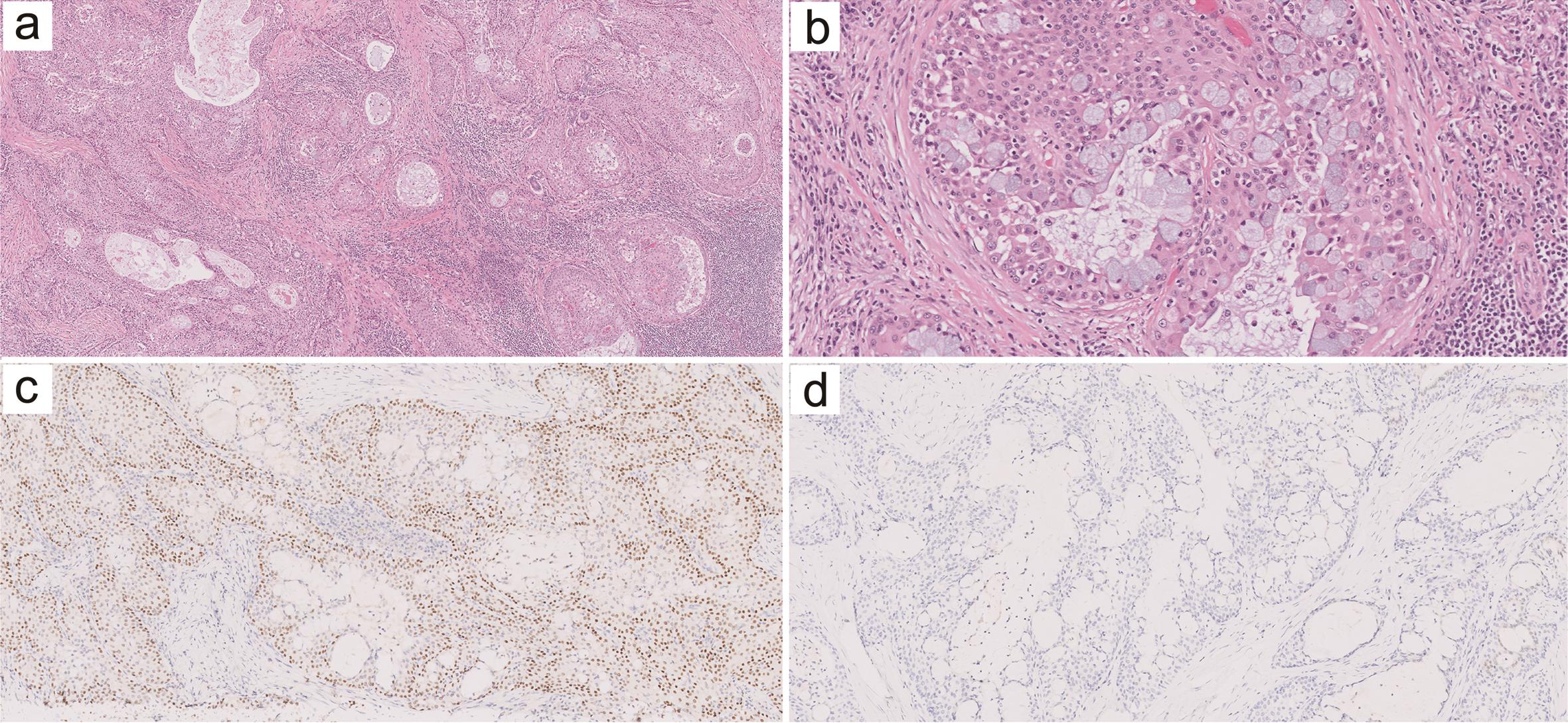 Low grade mucoepidermoid carcinoma.