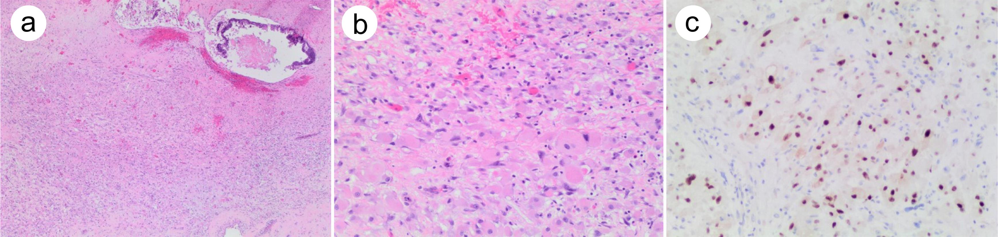 Rhabdomyosarcoma arising from testicular teratoma.
