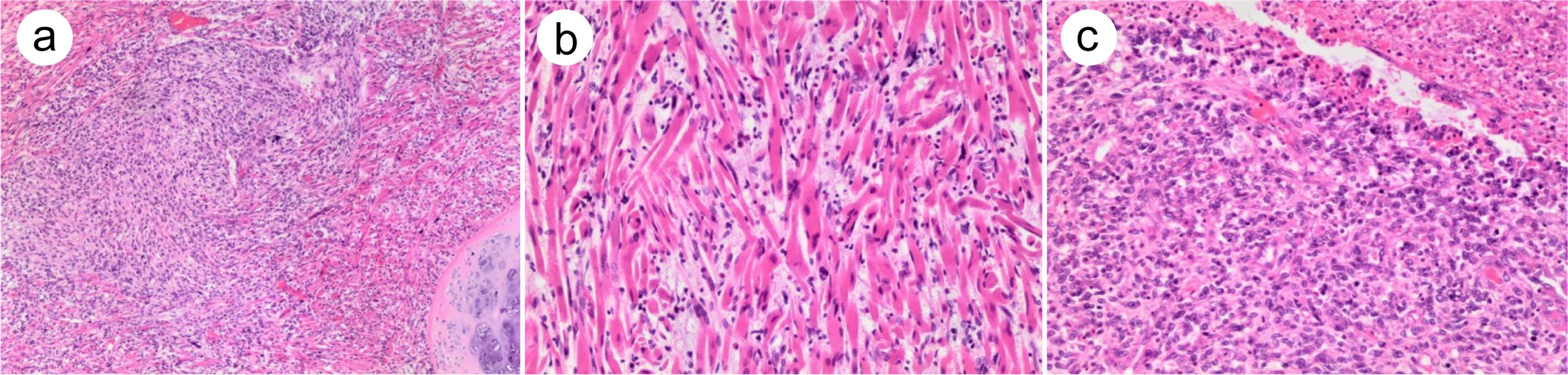 Leiomyosarcoma arising from teratoma.