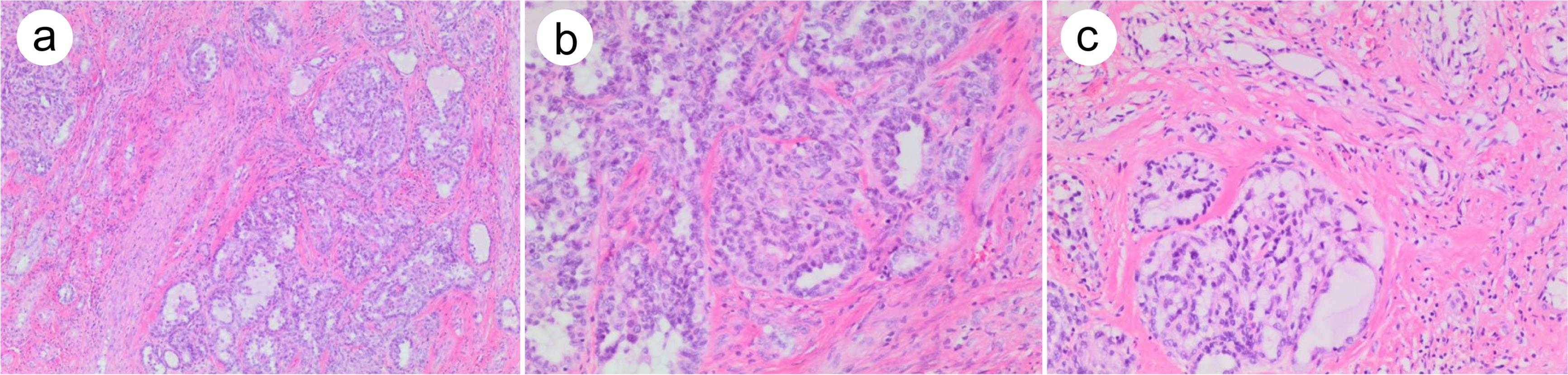 Adenocarcinoma arising from testicular teratoma.