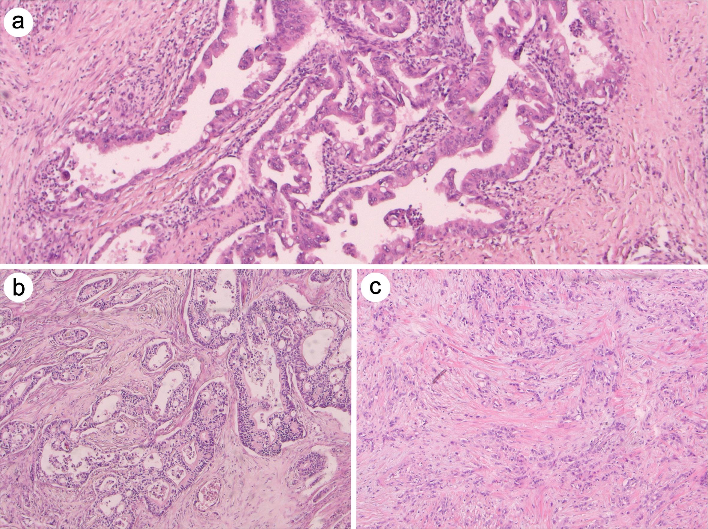 Representative images of pancreatic ductal adenocarcinoma (PDAC) showing tubular (a; hematoxylin and eosin (H&E), ×20), cribriform (b; H&E, ×10), and solid (c; H&E, ×10) growth patterns observed in selected areas.