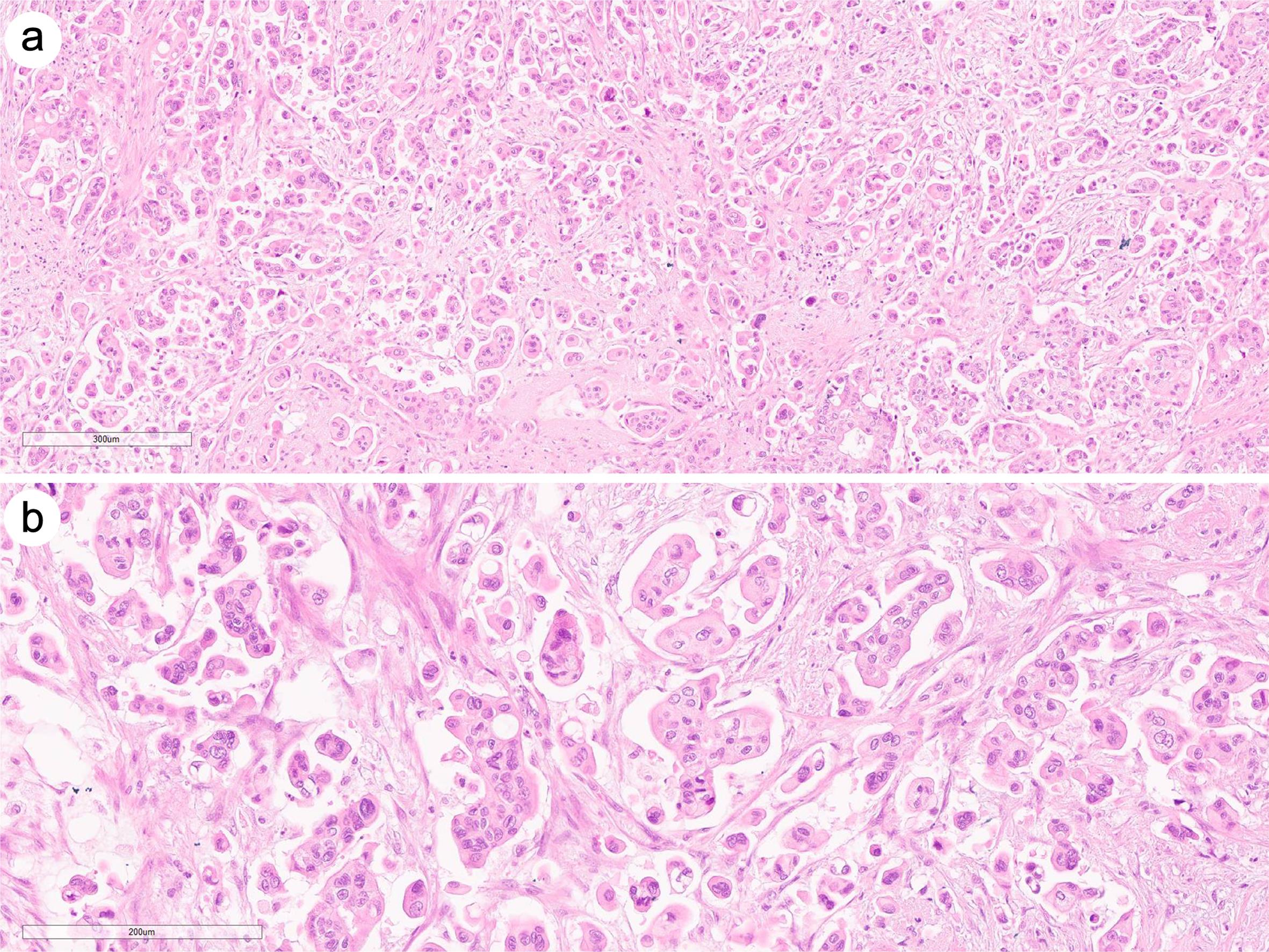 Representative image of a case with a micropapillary pattern >20%.