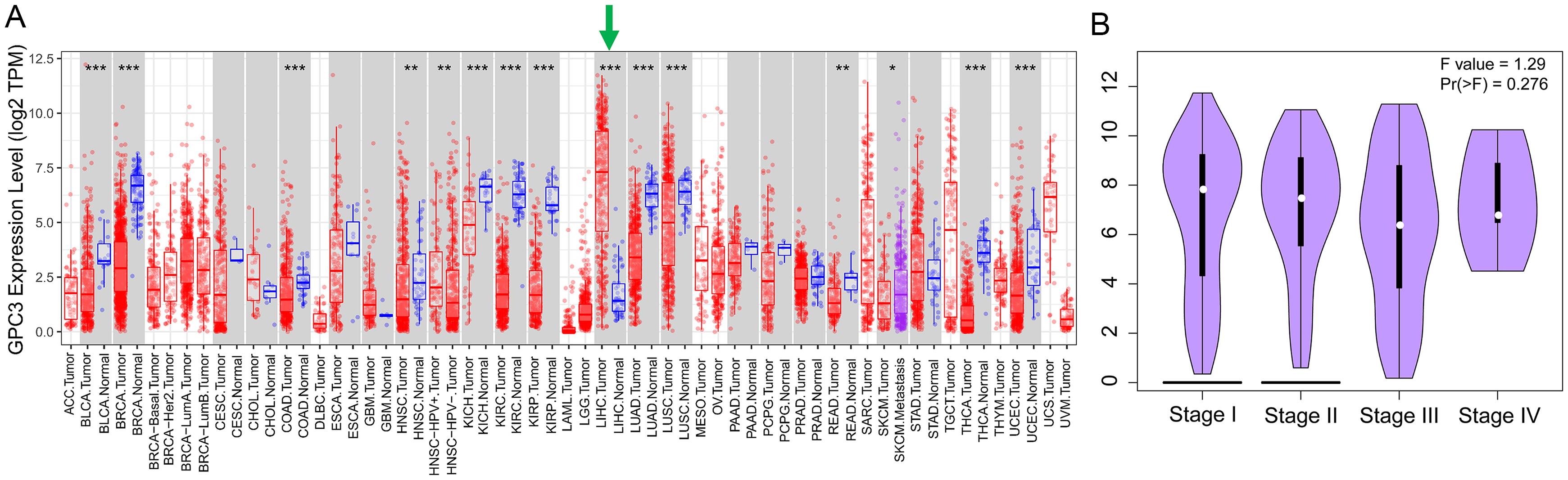 GPC3 expression across different tumors and pathological stages of HCC.