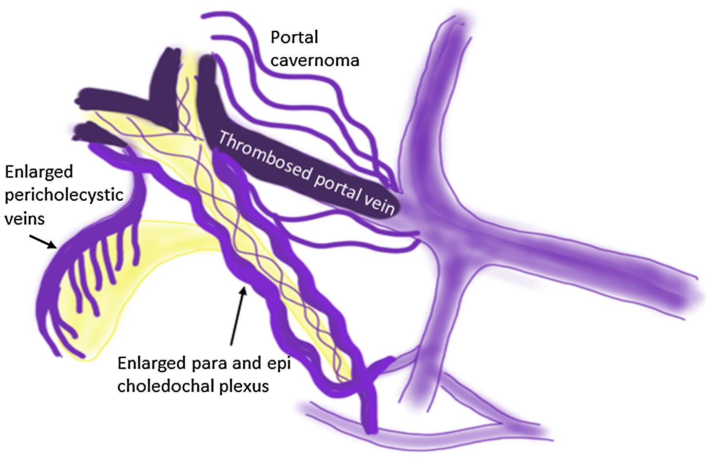 Enlargement of peribiliary collaterals and development of cholangiopathy after portal vein thrombosis.