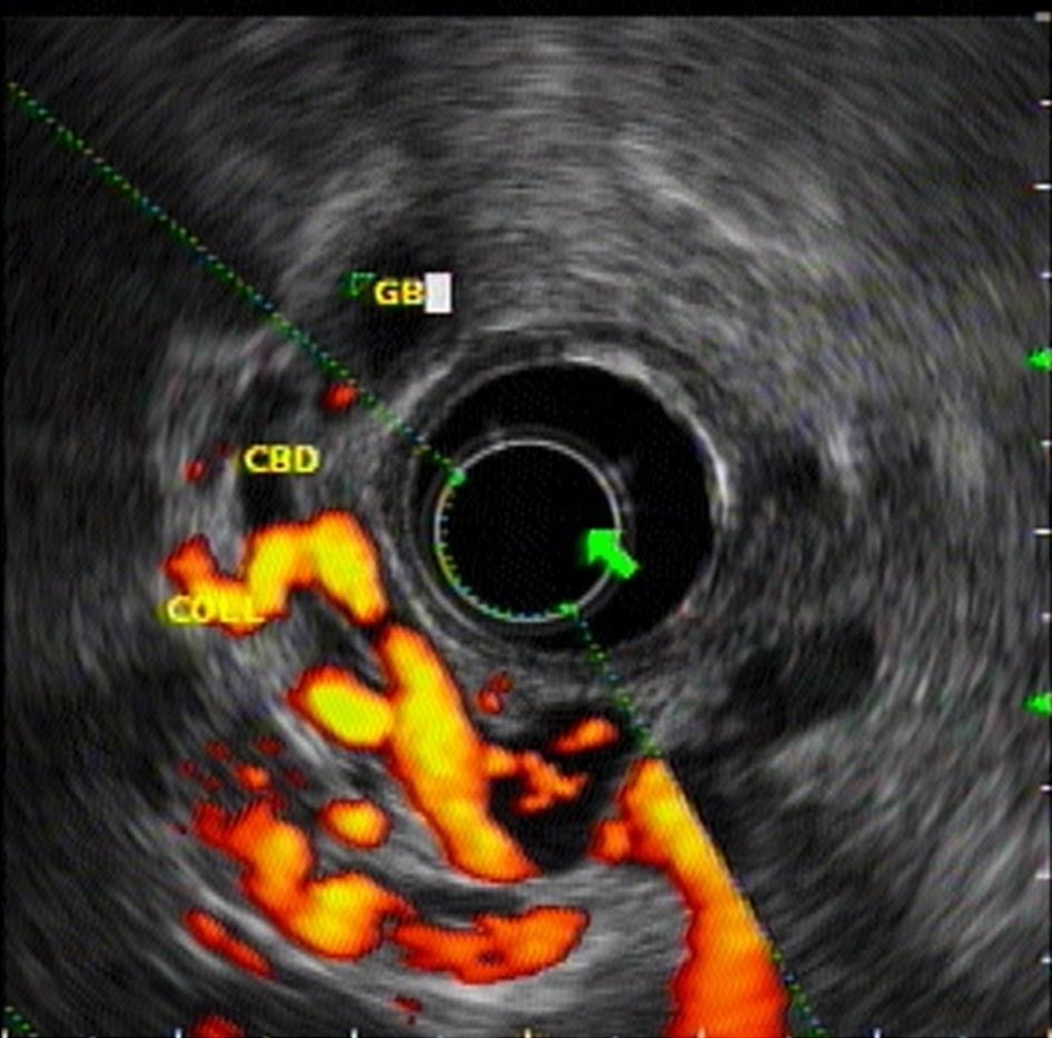 Endoscopic ultrasound Doppler image showing dilated common bile duct engulfed by collaterals.