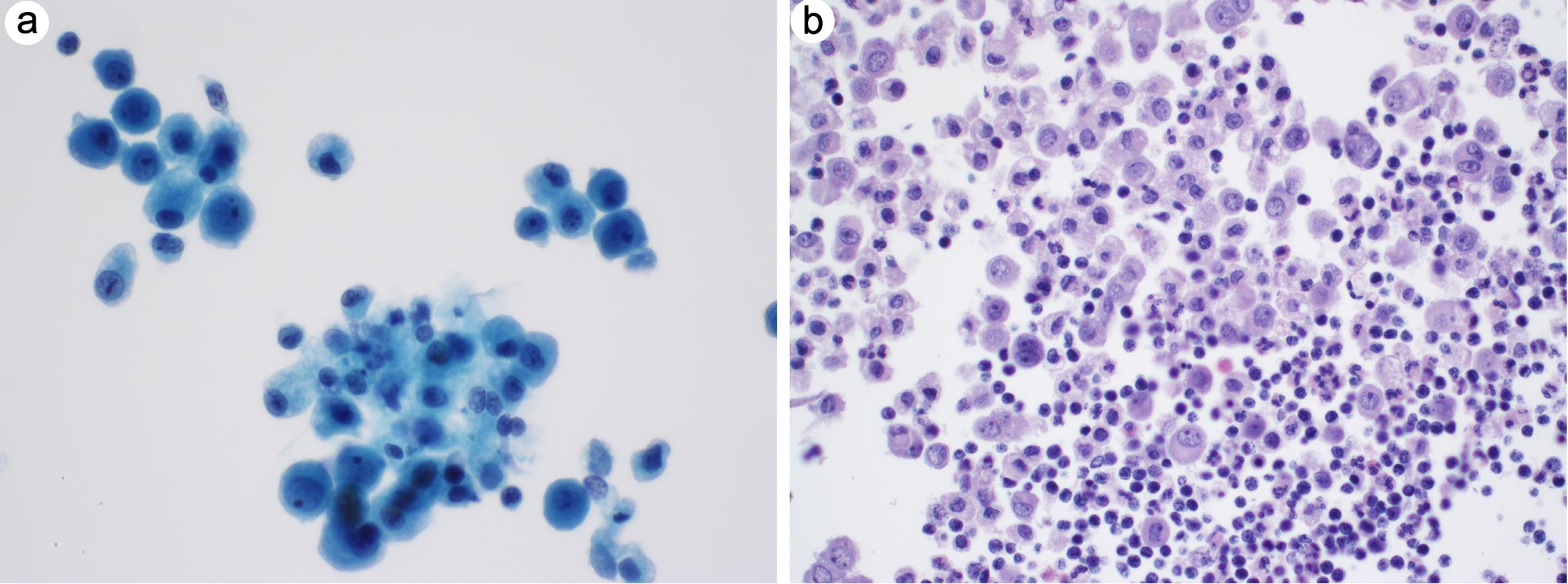 Reactive mesothelial cells, histiocytes, and small lymphocytes.