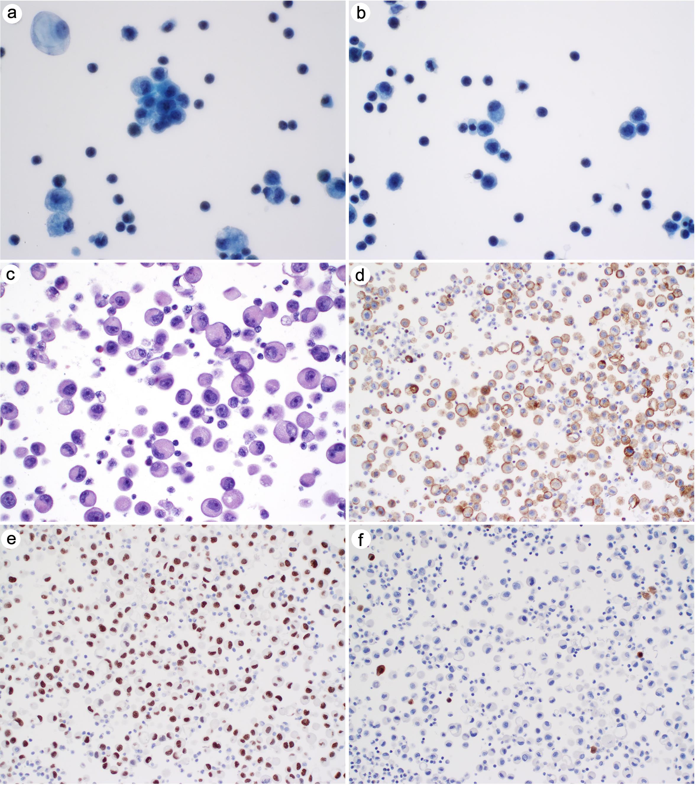 Metastatic lung adenocarcinoma in pleural fluid.