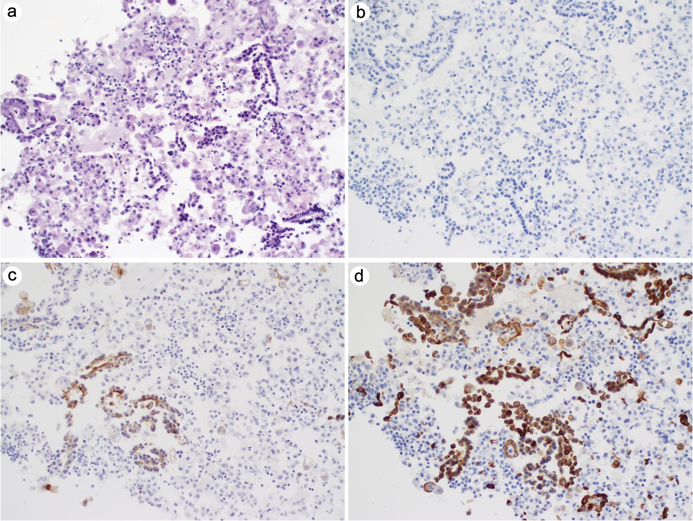 Cells with BerEp4 positivity may be reactive mesothelial cells.