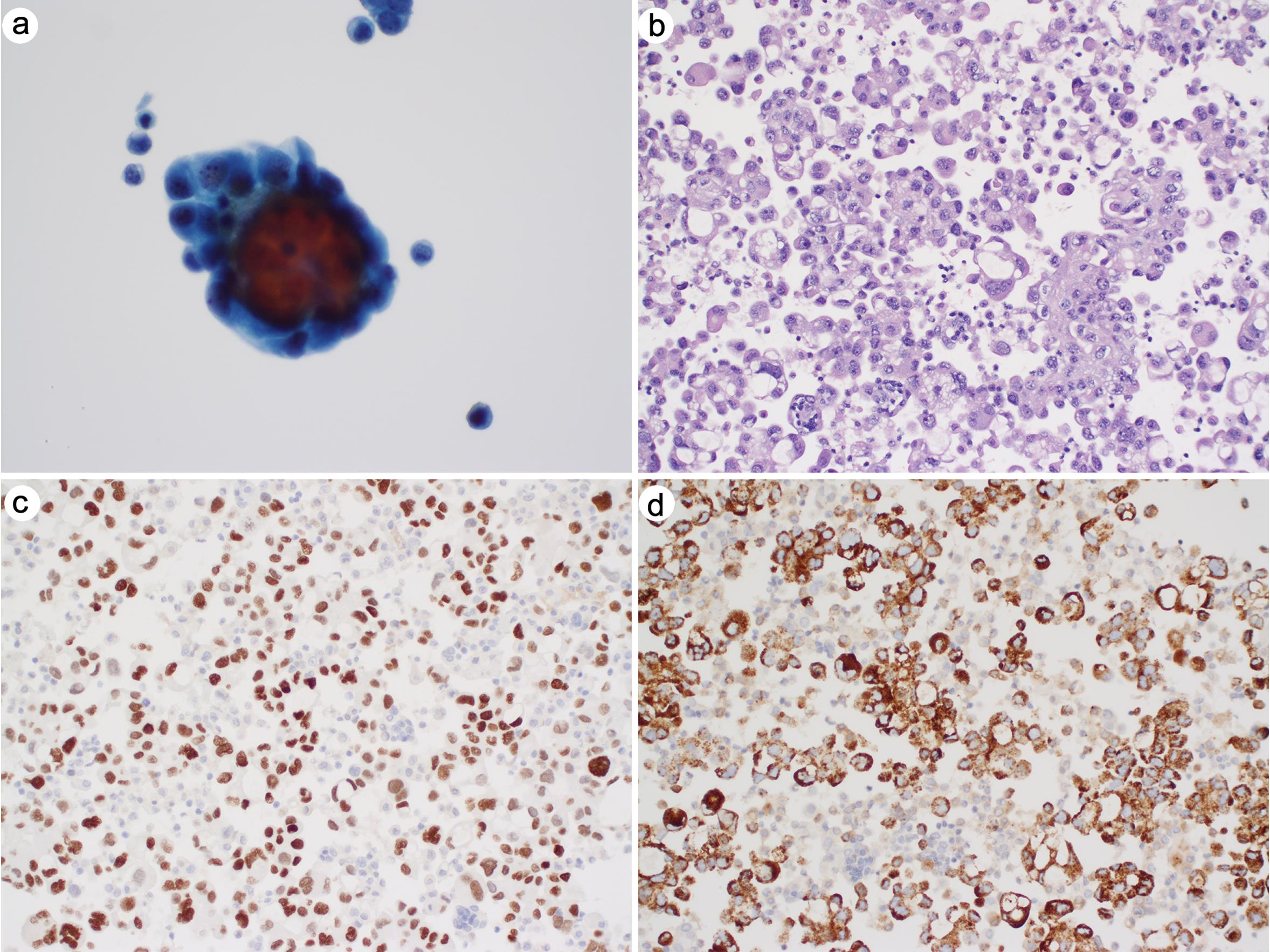 Metastatic adenocarcinoma with lung primary.