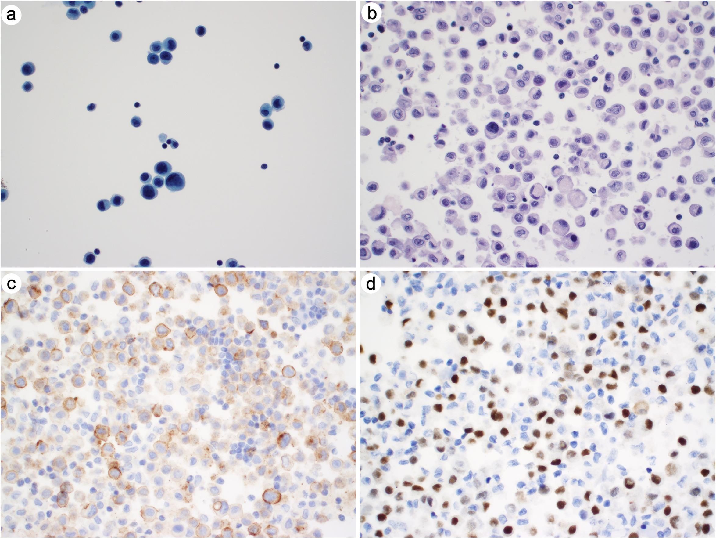 Metastatic breast lobular carcinoma in pleural fluid.