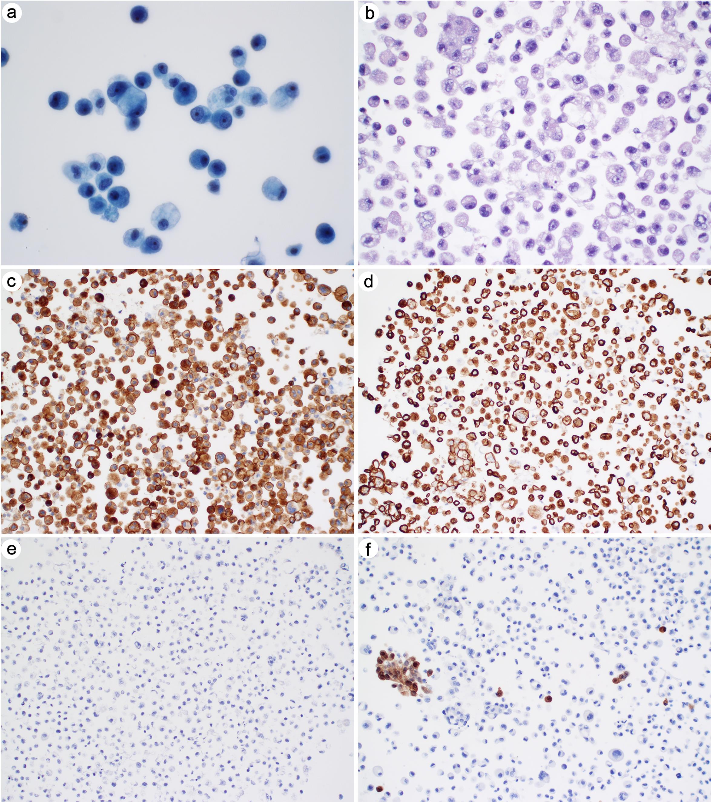 Metastatic adenocarcinoma of gastrointestinal primary.