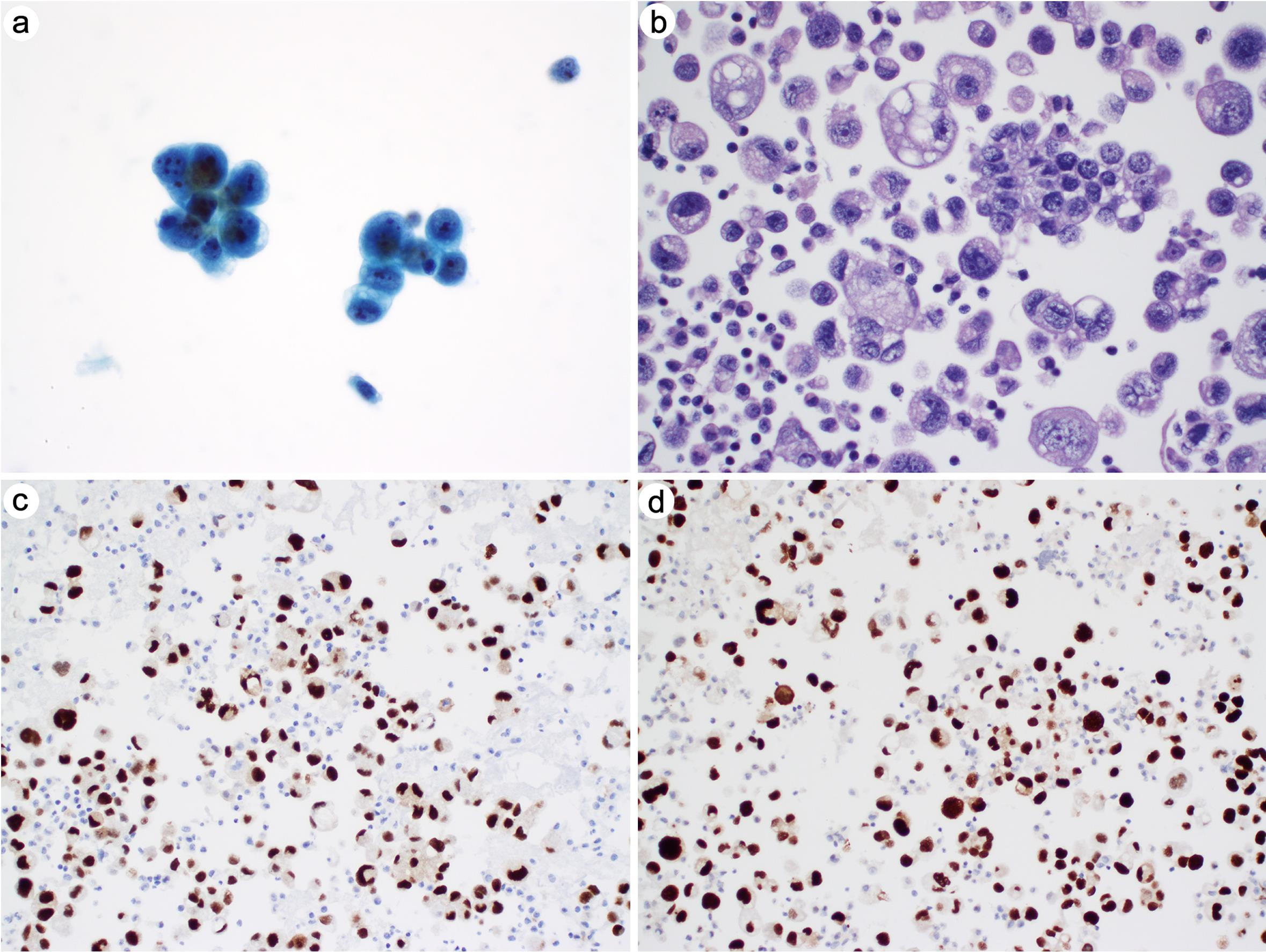 Metastatic serous carcinoma in pleural fluid.