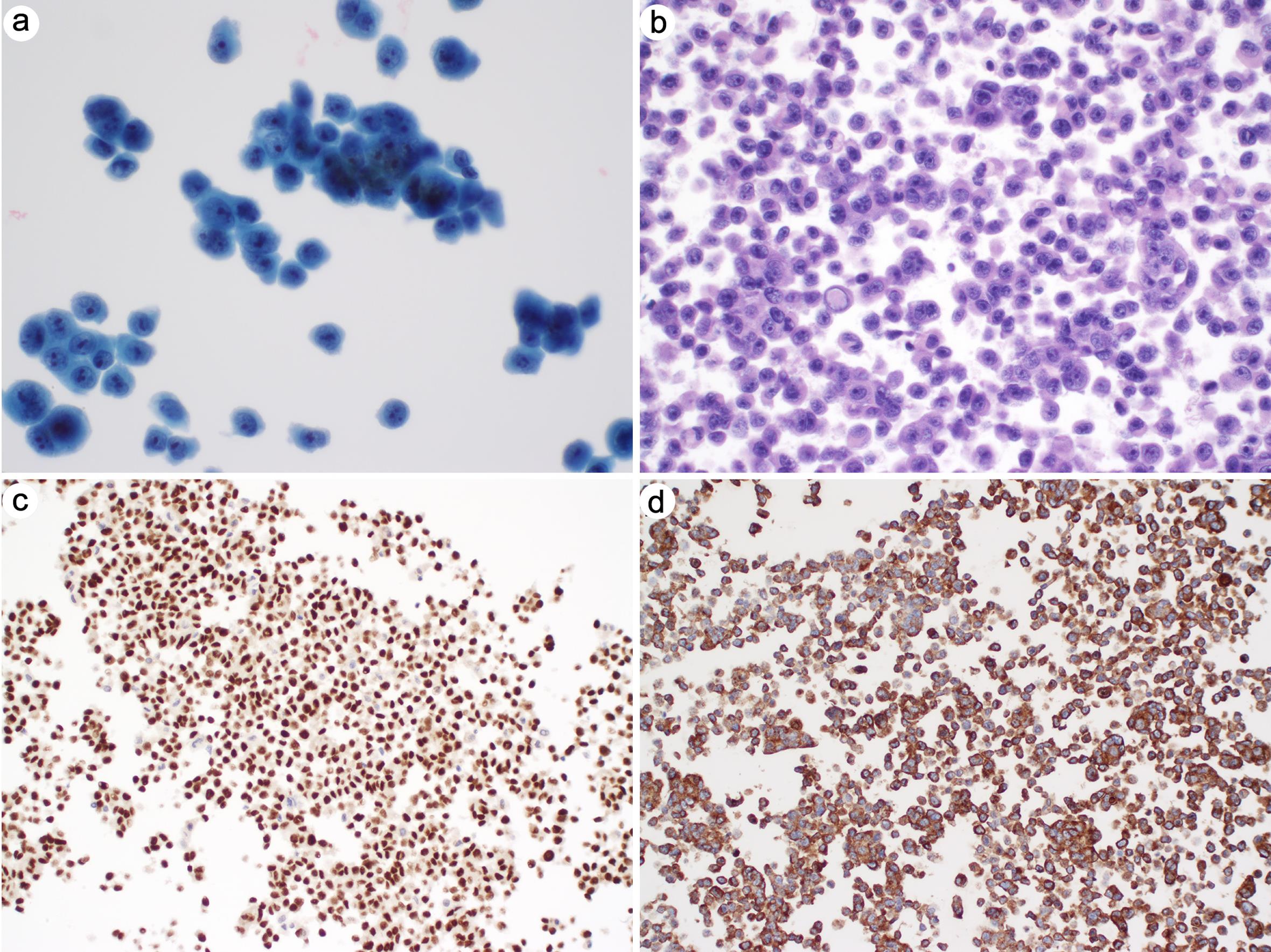 Metastatic melanoma in pleural fluid.