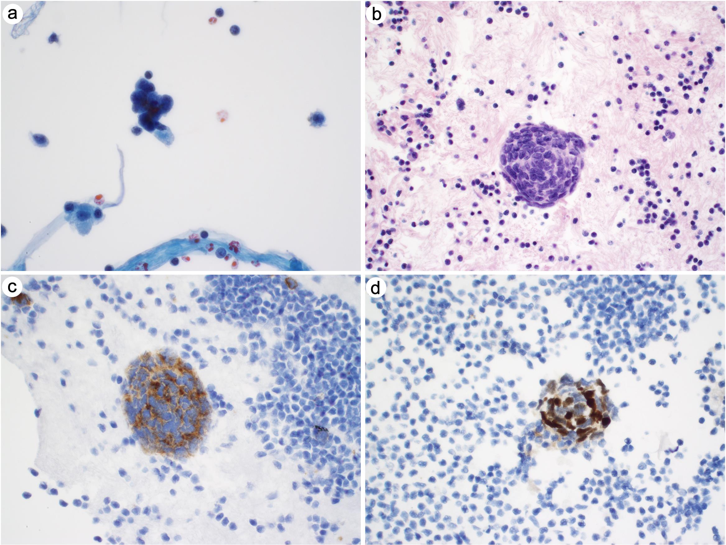 Metastatic small cell carcinoma in pleural fluid.