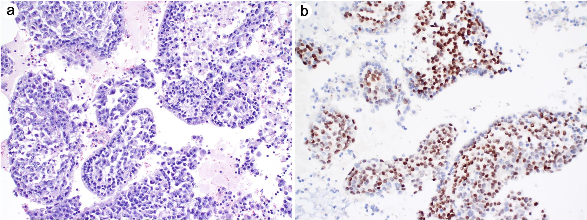 Metastatic prostatic adenocarcinoma in pleural fluid.