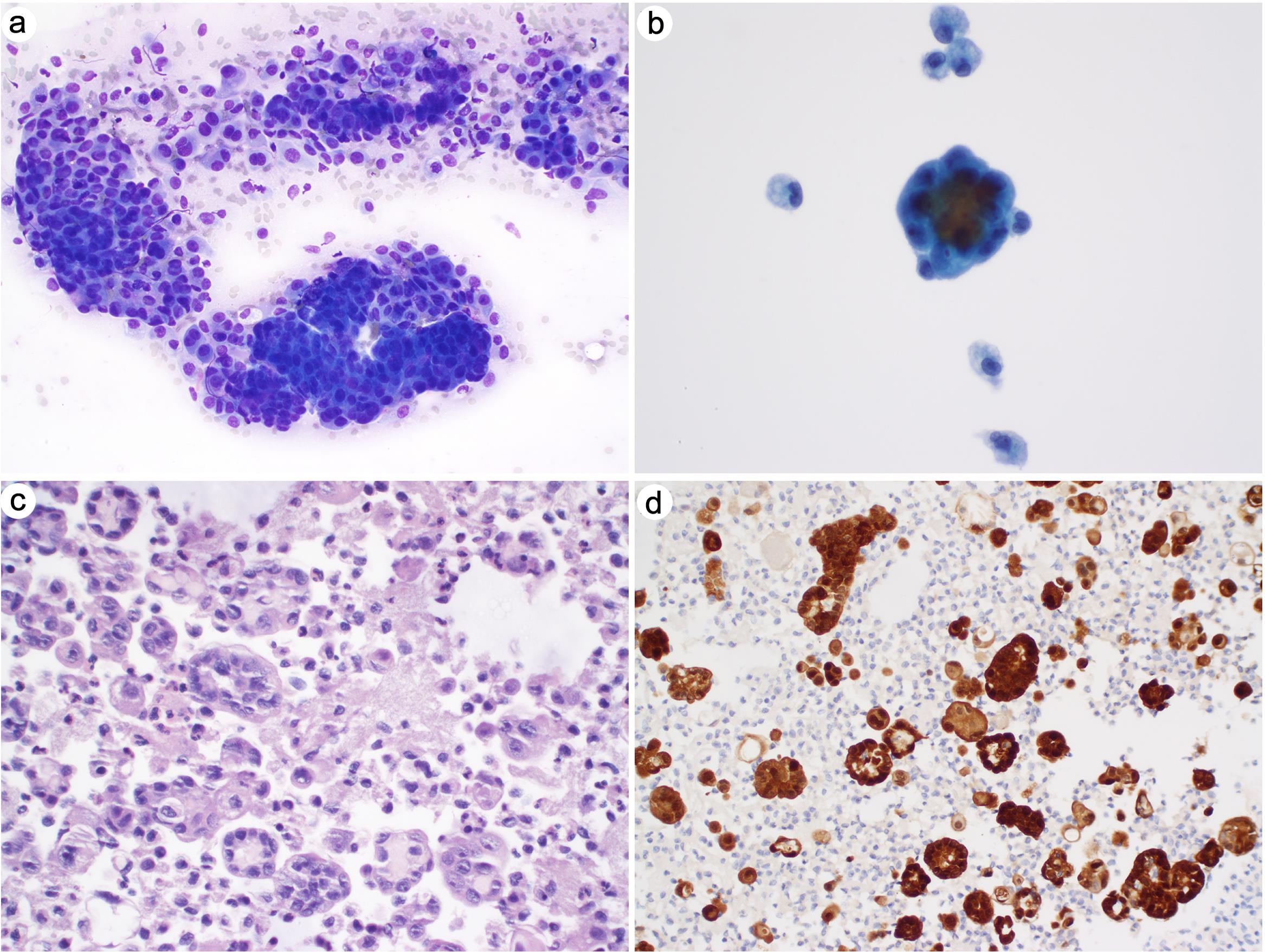 Malignant mesothelioma.