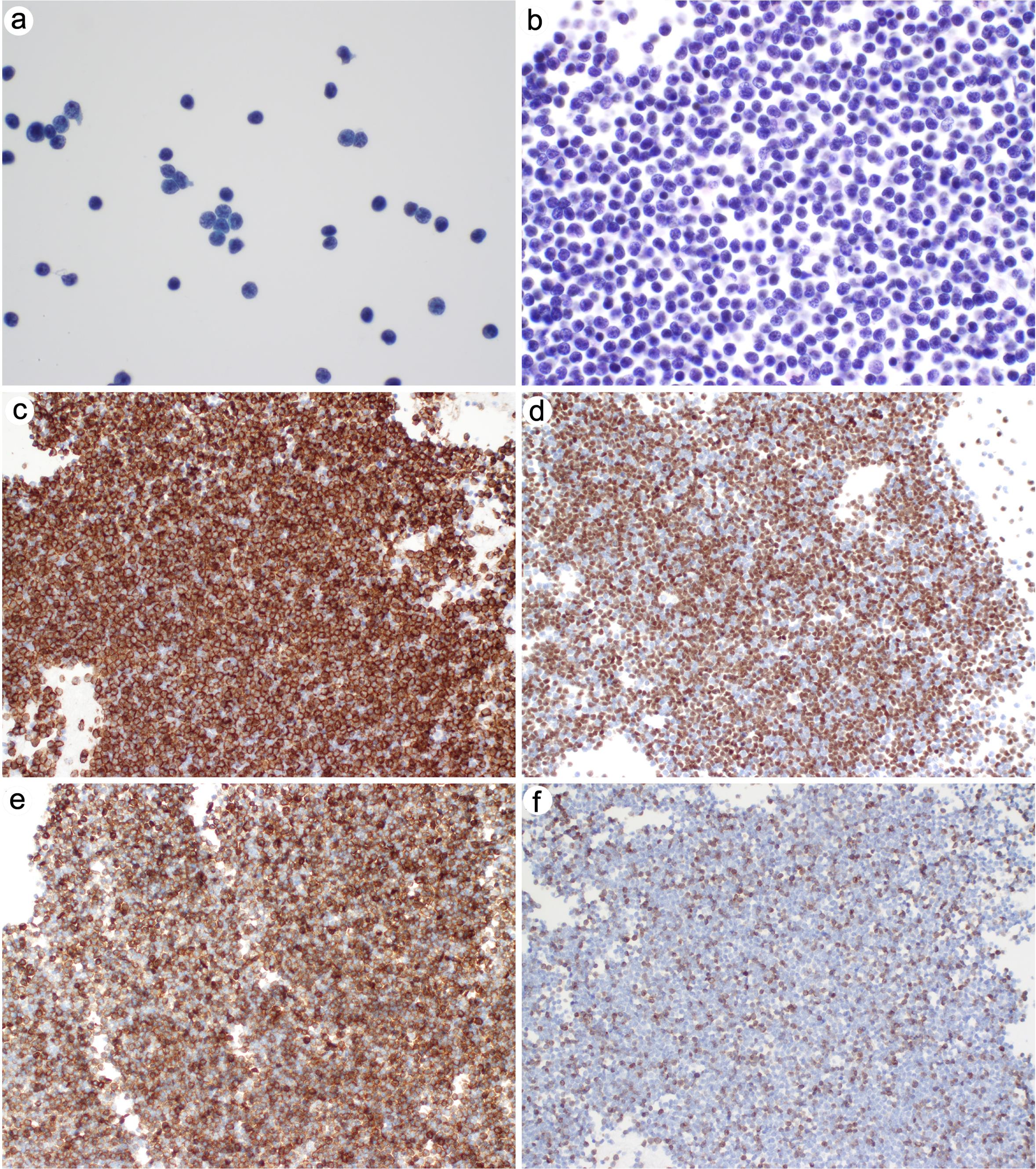 Chronic lymphocytic leukemia in pleural effusion. Small to medium-sized lymphocytes are monotonous.