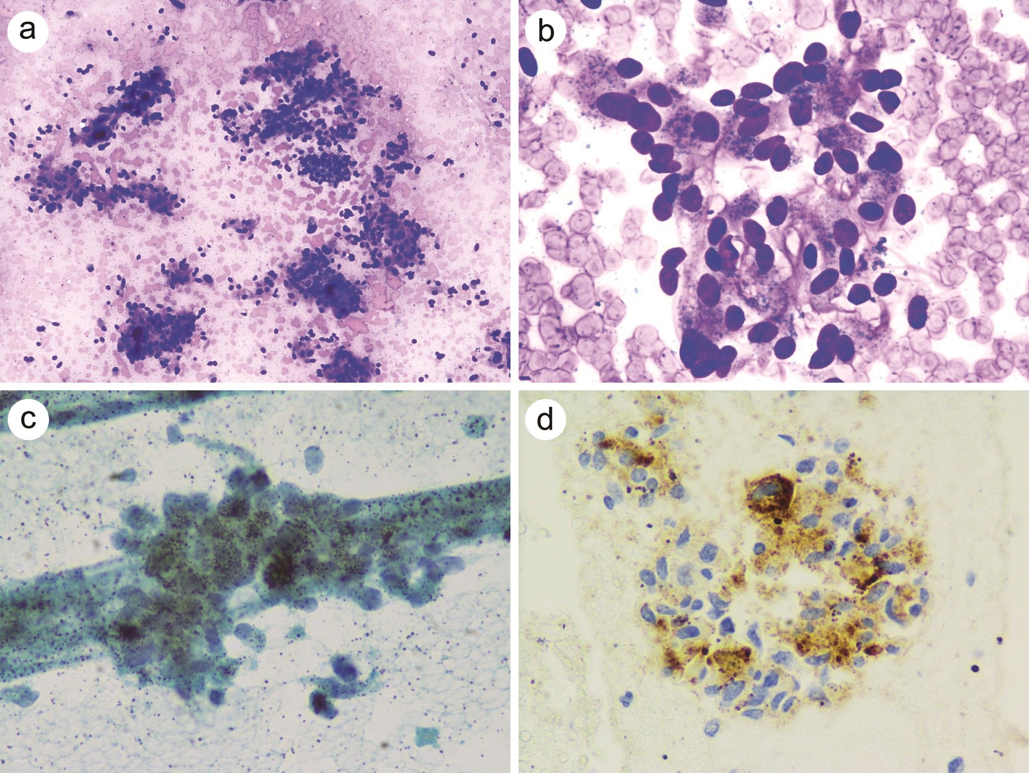 Pigmented variant of pancreatic neuroendocrine tumors.