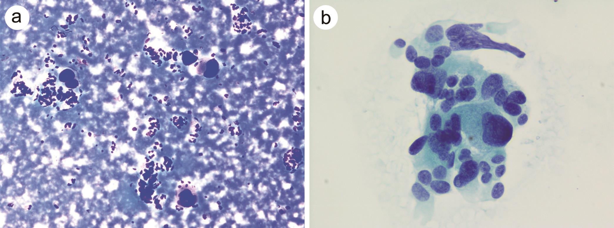 Pleomorphic variant of pancreatic neuroendocrine tumors.