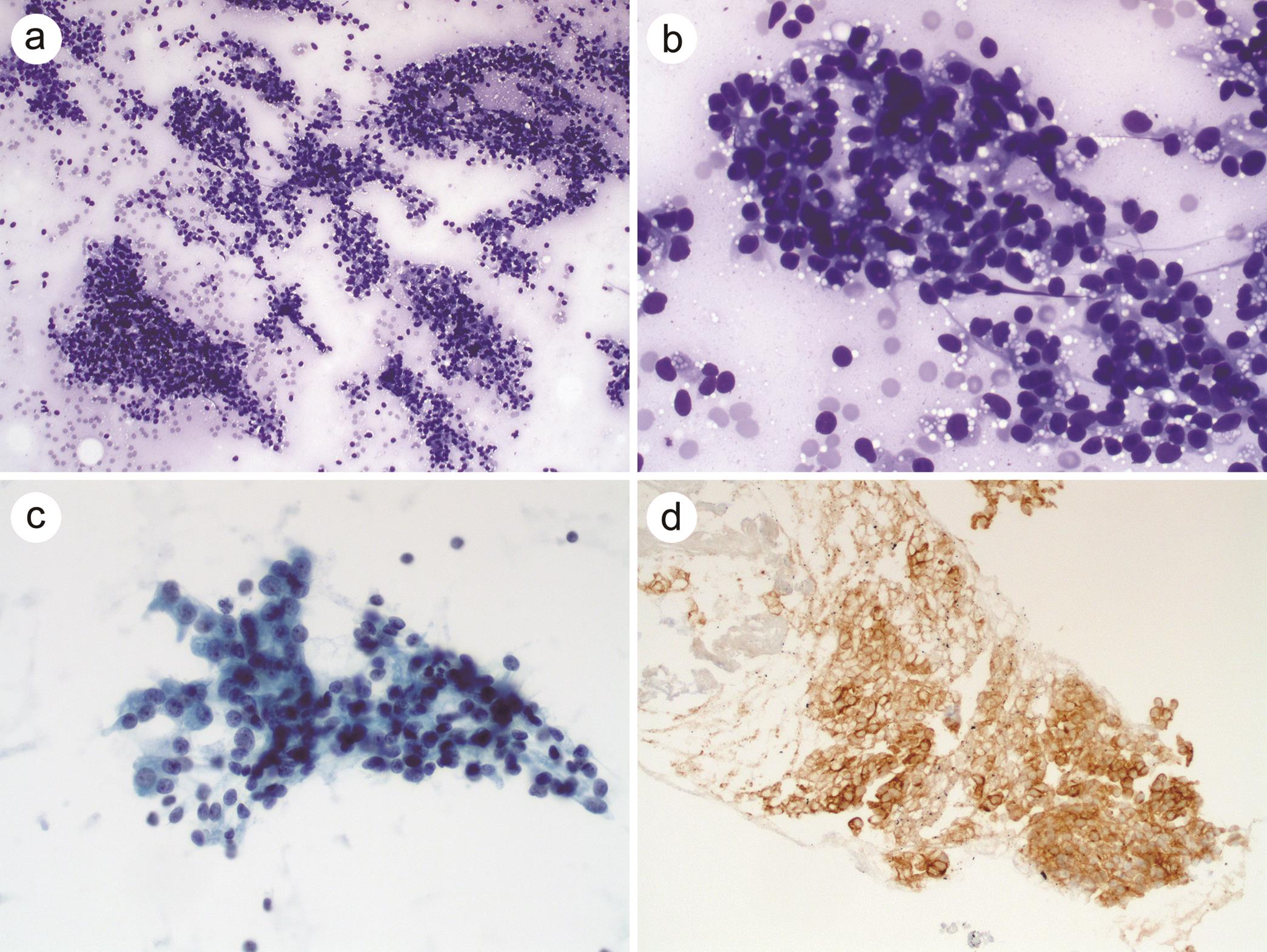 Clear cell/lipid-rich variant of pancreatic neuroendocrine tumors.