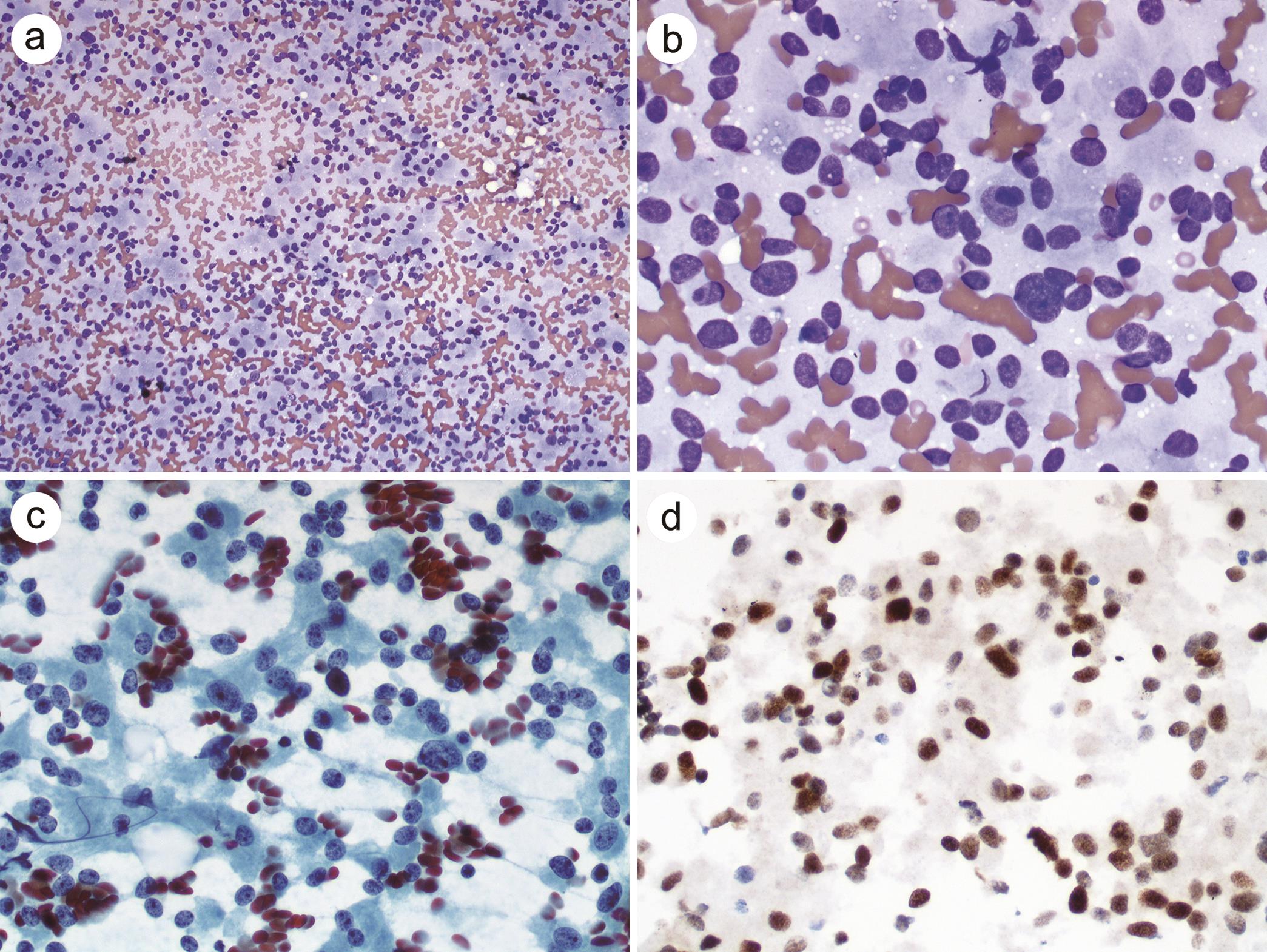 Oncocytic variant of pancreatic neuroendocrine tumors.