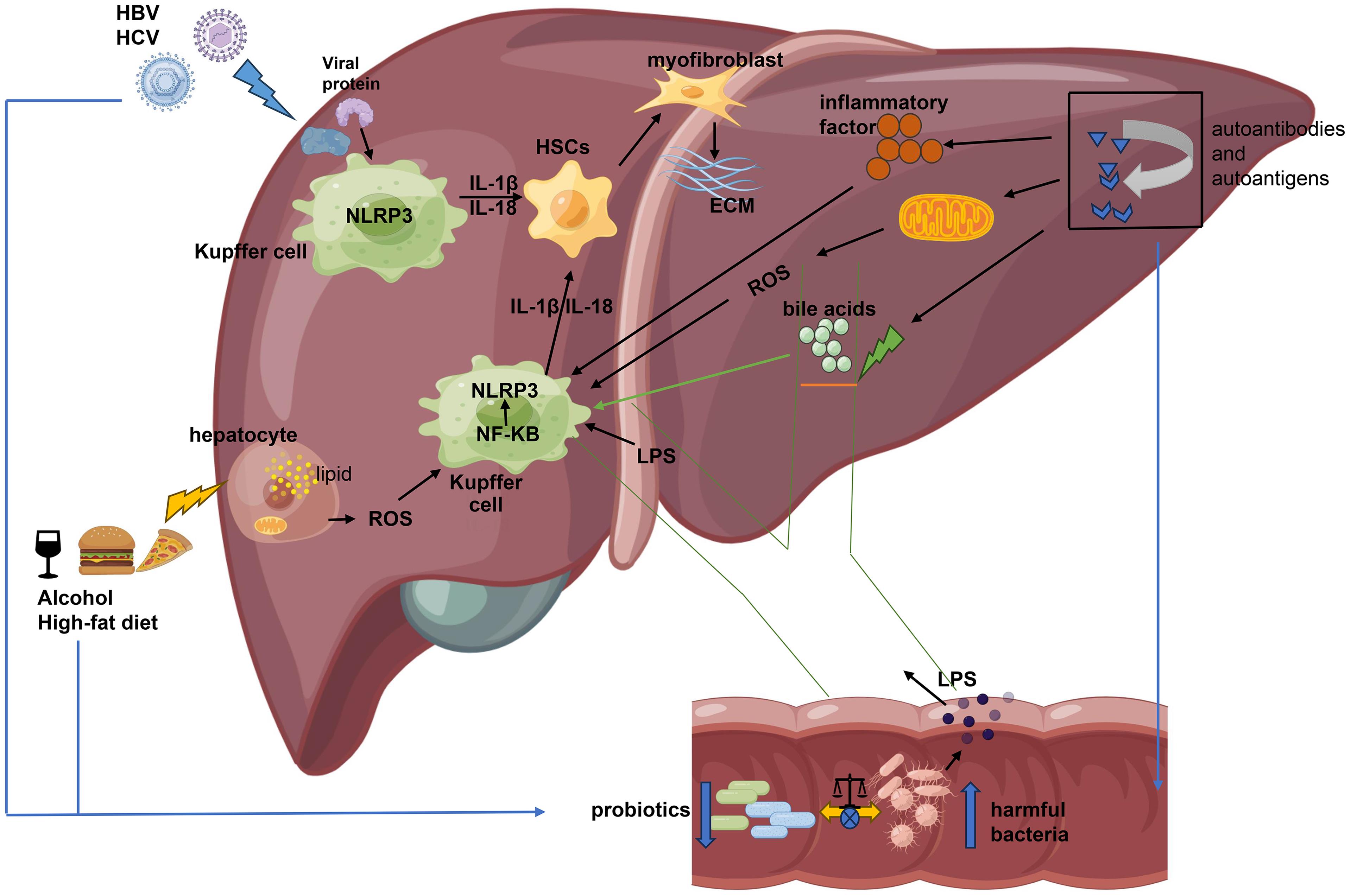 Activation of NLRP3 inflammasome in chronic liver disease.