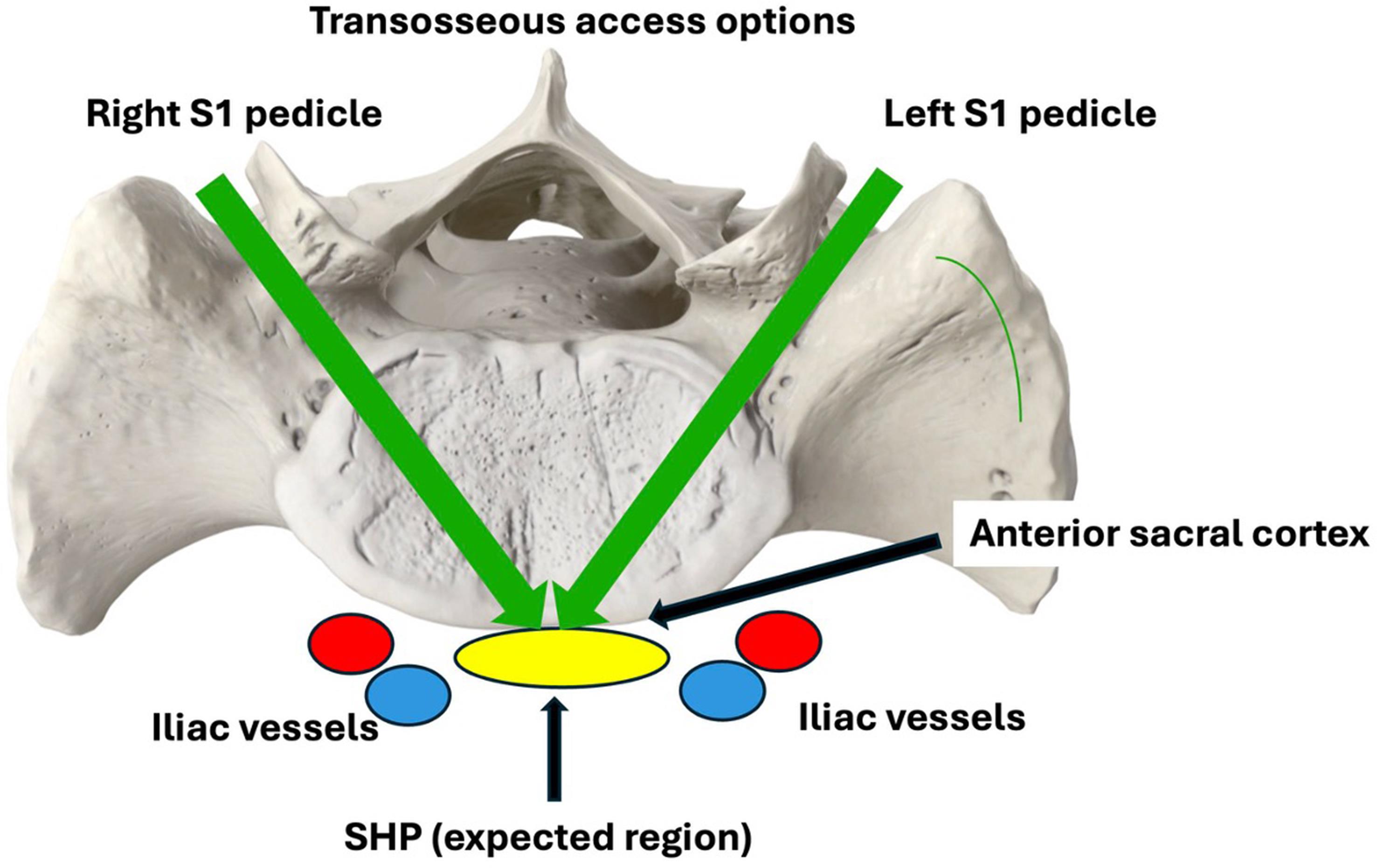 Schematic representation of bilateral posterior transosseous S1 pedicle access trajectories toward the superior hypogastric plexus region.