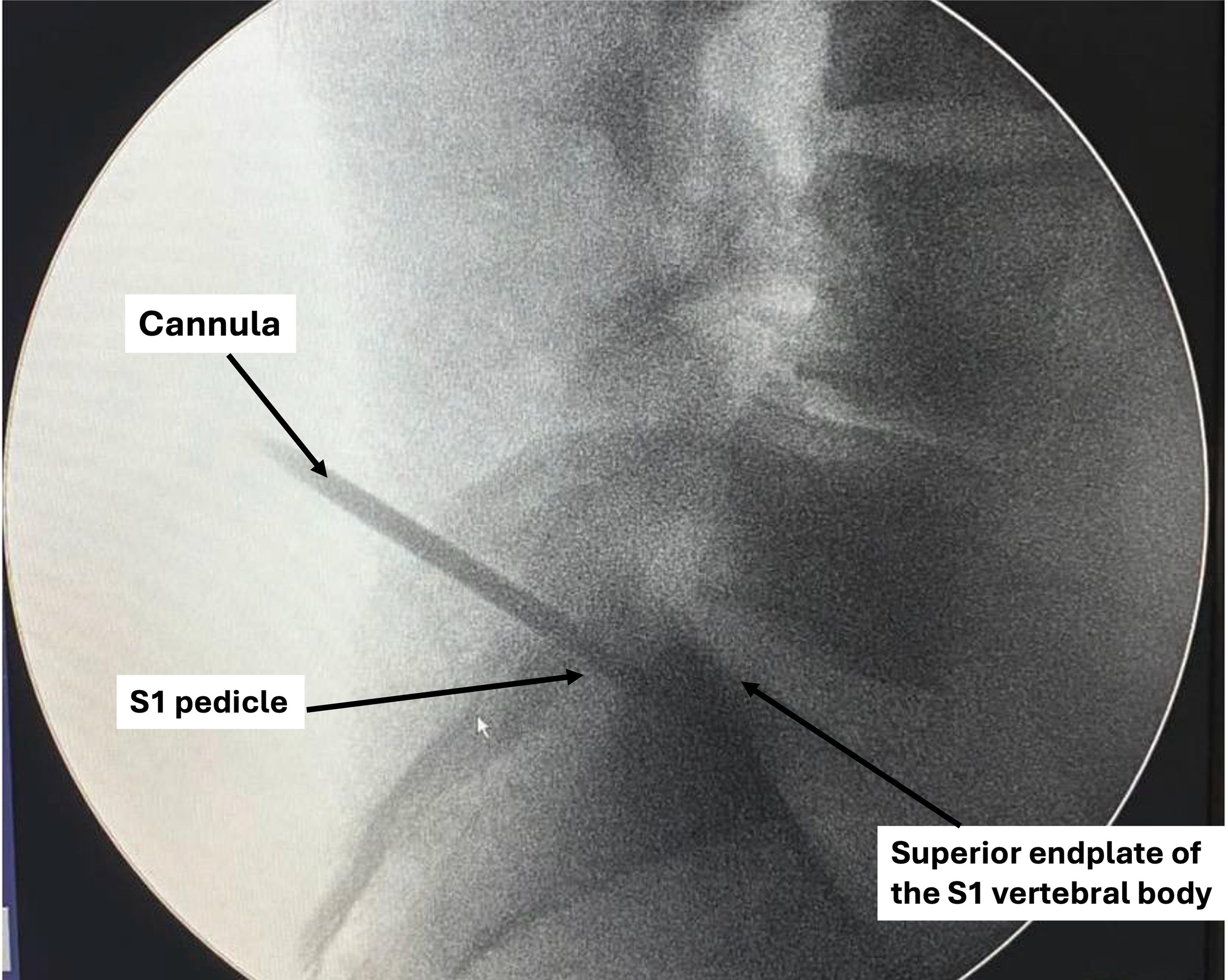 Lateral fluoroscopic view demonstrating cannula advancement through the S1 pedicle.