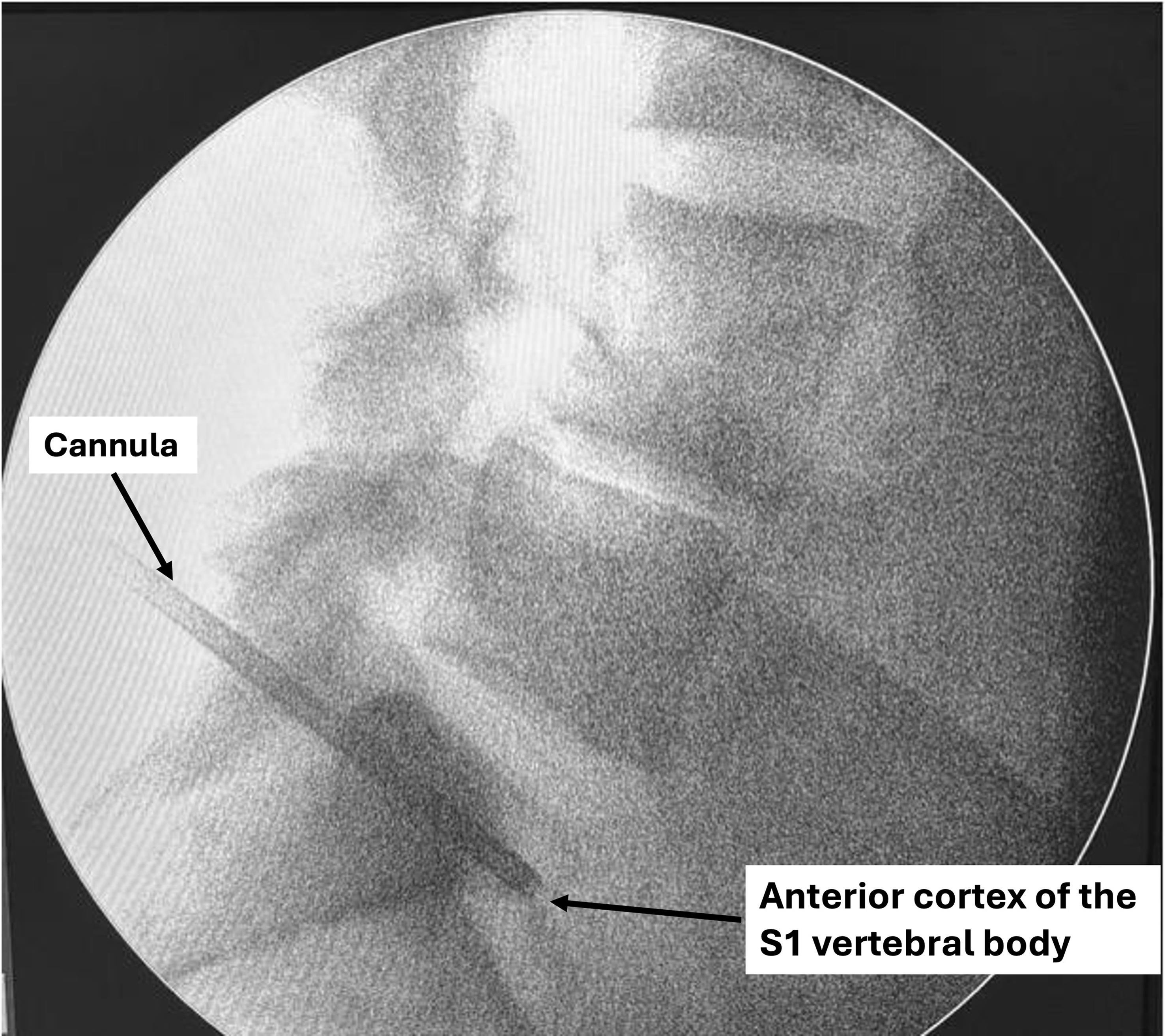 Lateral fluoroscopic view showing transosseous cannula positioning with controlled contact with the anterior cortex of the S1 vertebral body, supporting the anatomical plausibility of accessing the retroperitoneal space via this route.