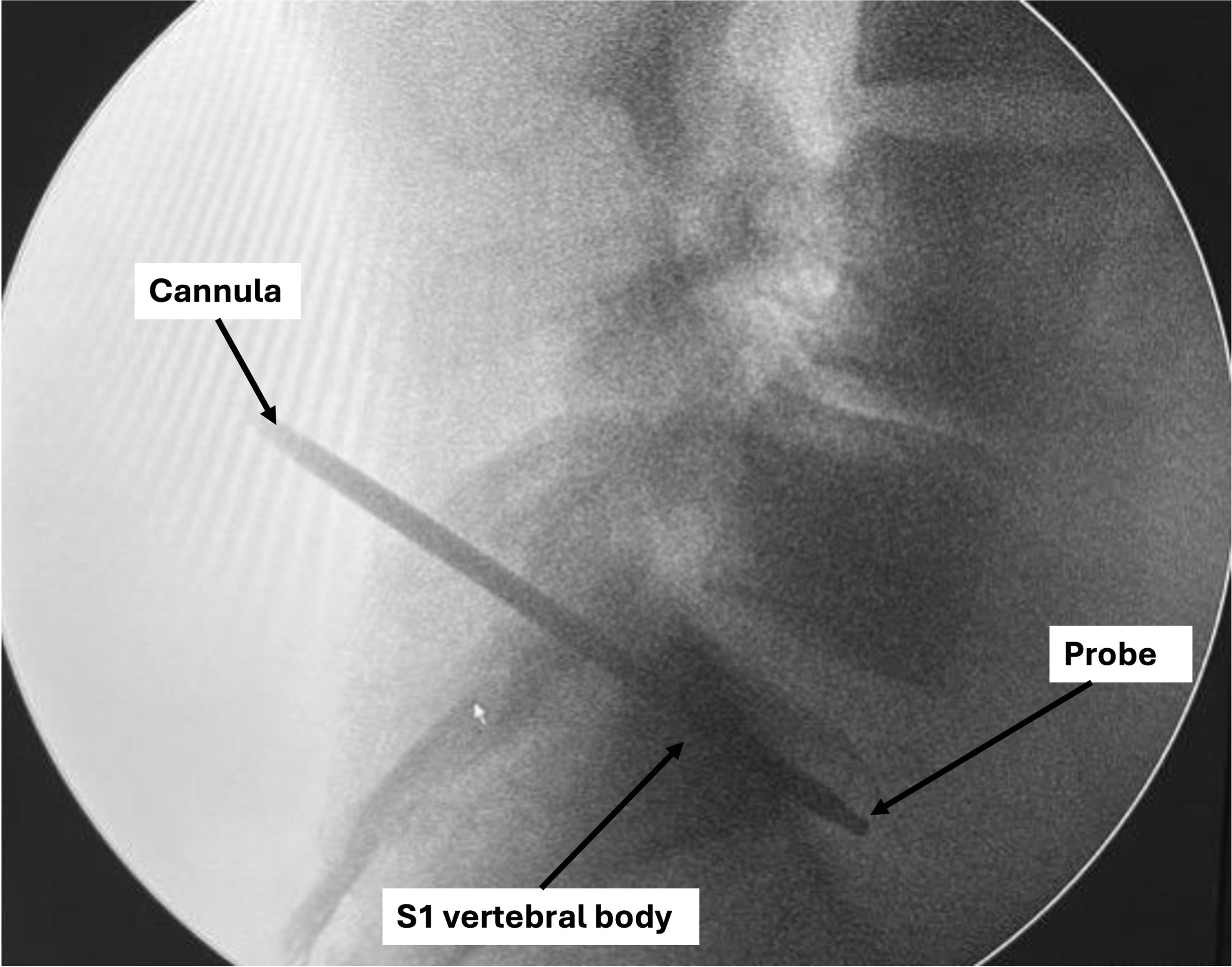 Lateral fluoroscopic view demonstrating insertion of a probe through the transosseous cannula to verify anterior cortical breach of the S1 vertebral body within the proposed anatomical pathway.