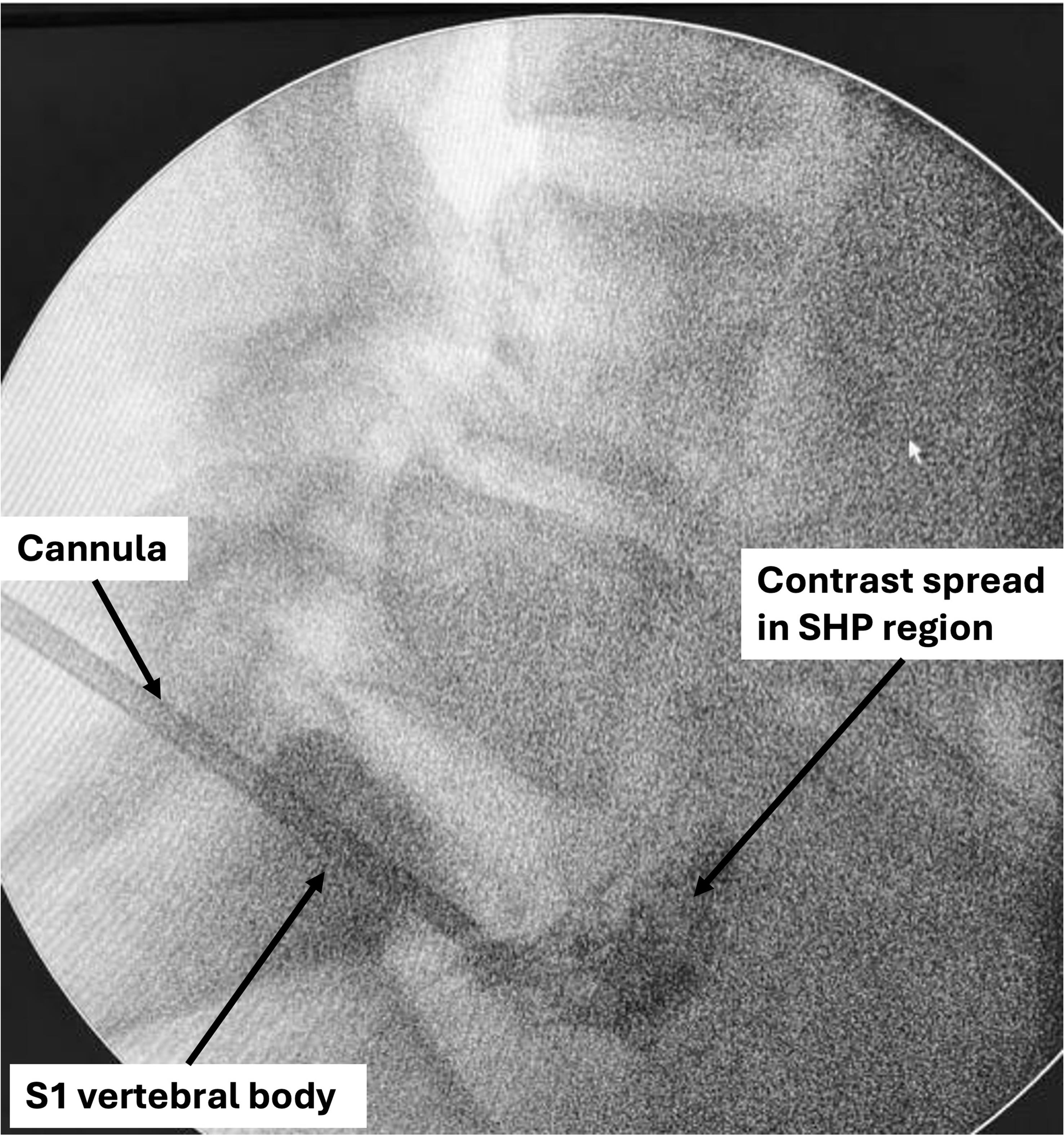 Fluoroscopic image demonstrating contrast spread compatible with the expected anatomical region of the superior hypogastric plexus, without direct anatomical confirmation.