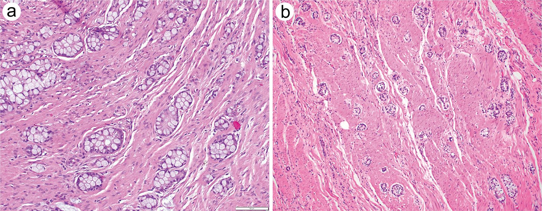 Overinterpretation is common in pathological diagnosis of appendix cancer  during patient referral for oncologic care | PLOS ONE