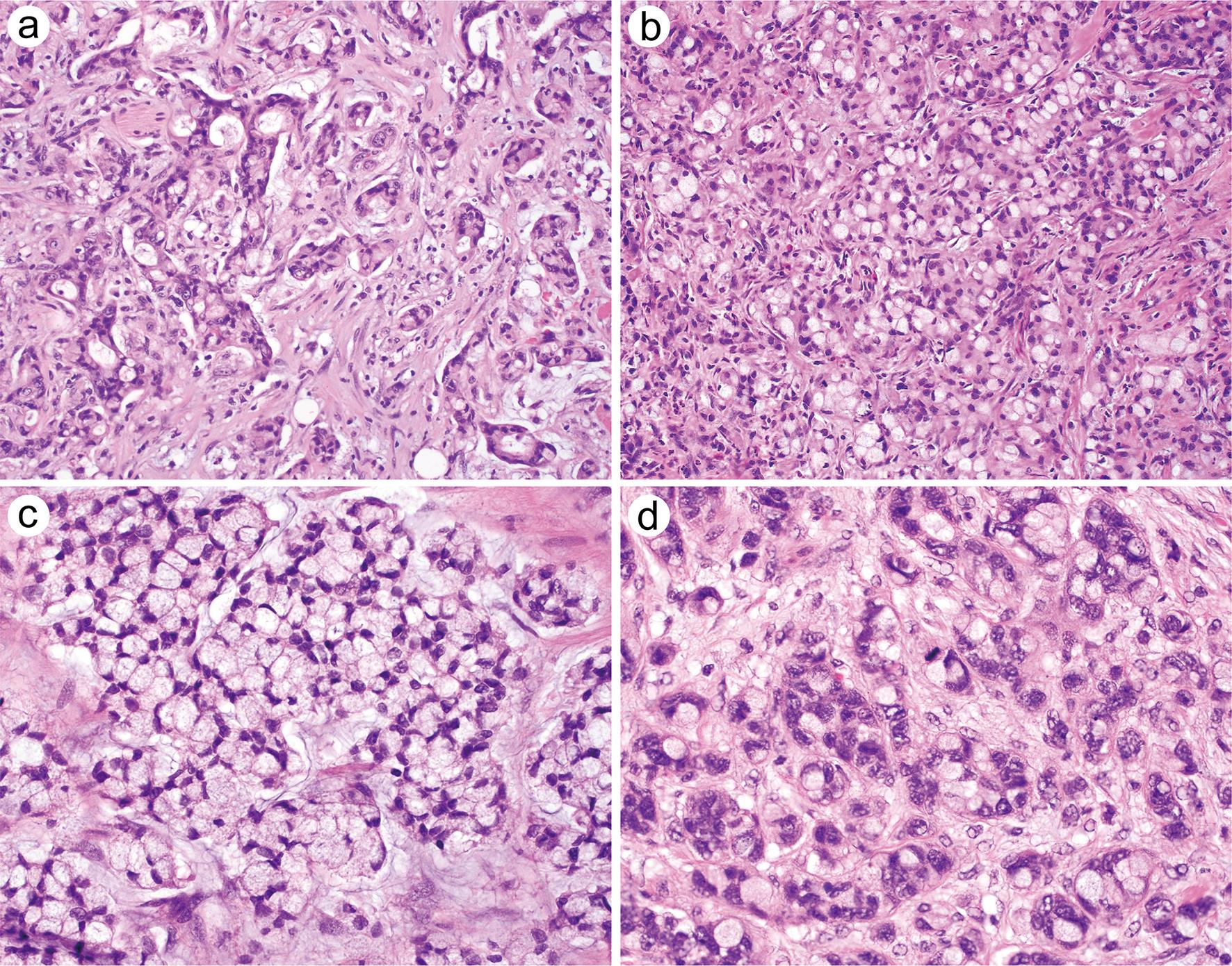 High-grade patterns of goblet cell adenocarcinoma showing conventional adenocarcinomatous component in a desmoplastic stroma (a, original magnification ×200) and/or large irregular sheets of goblet-like or signet-ring-like cells (b, original magnification ×200).