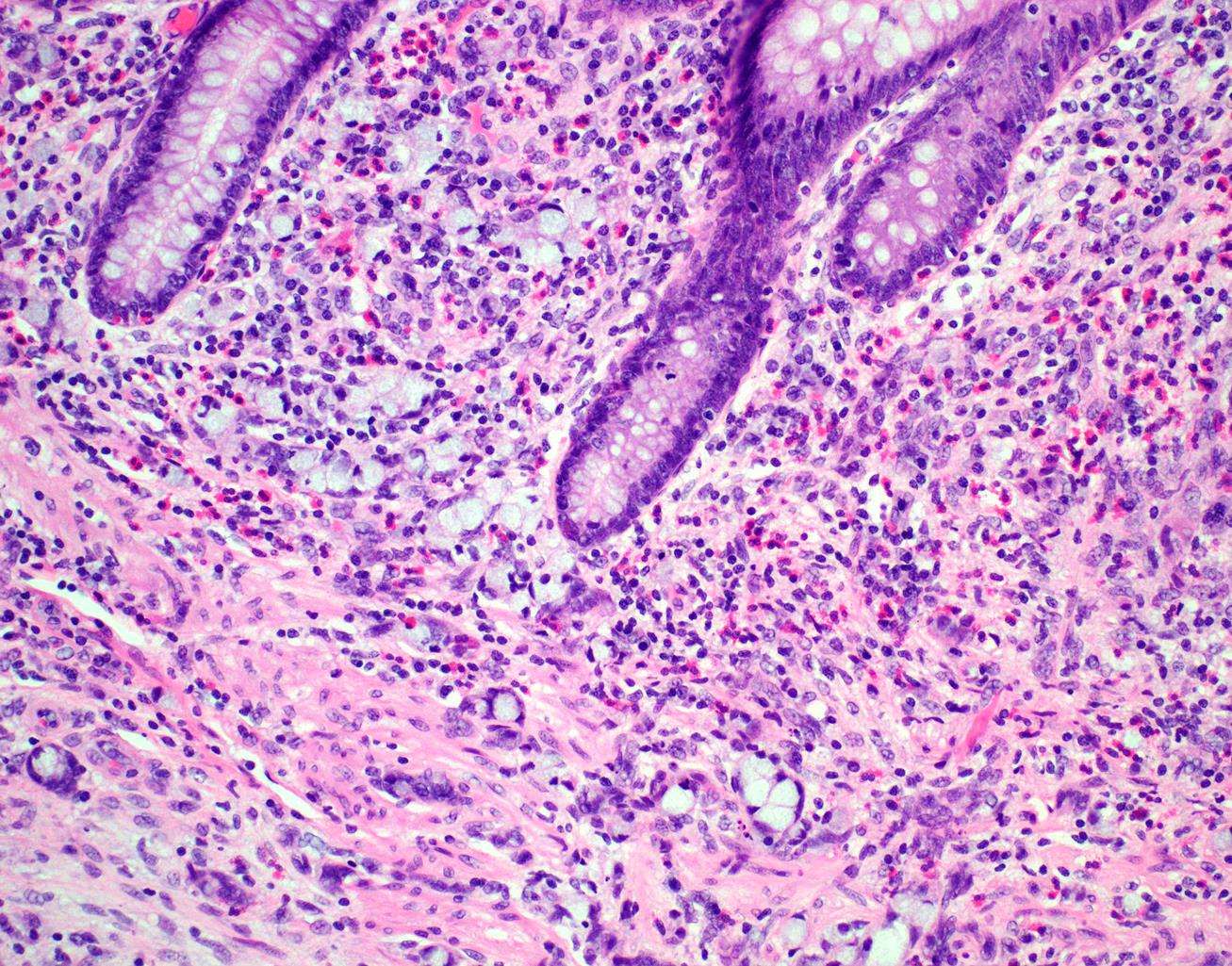 Tumor clusters and single signet-ring-like cells are present around the base of crypts.